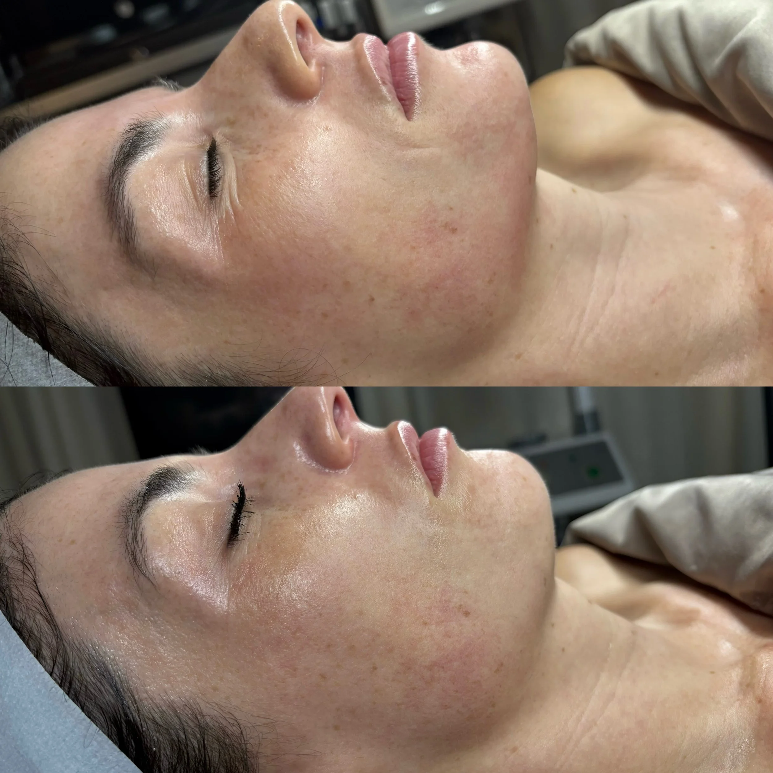 If you&rsquo;re in your 30s or 40s and starting to notice that your skin doesn&rsquo;t look as smooth, firm, or refined as it used to &ndash; this is the kind of results we&rsquo;re working towards. 

This guest committed to a series of Microneedling