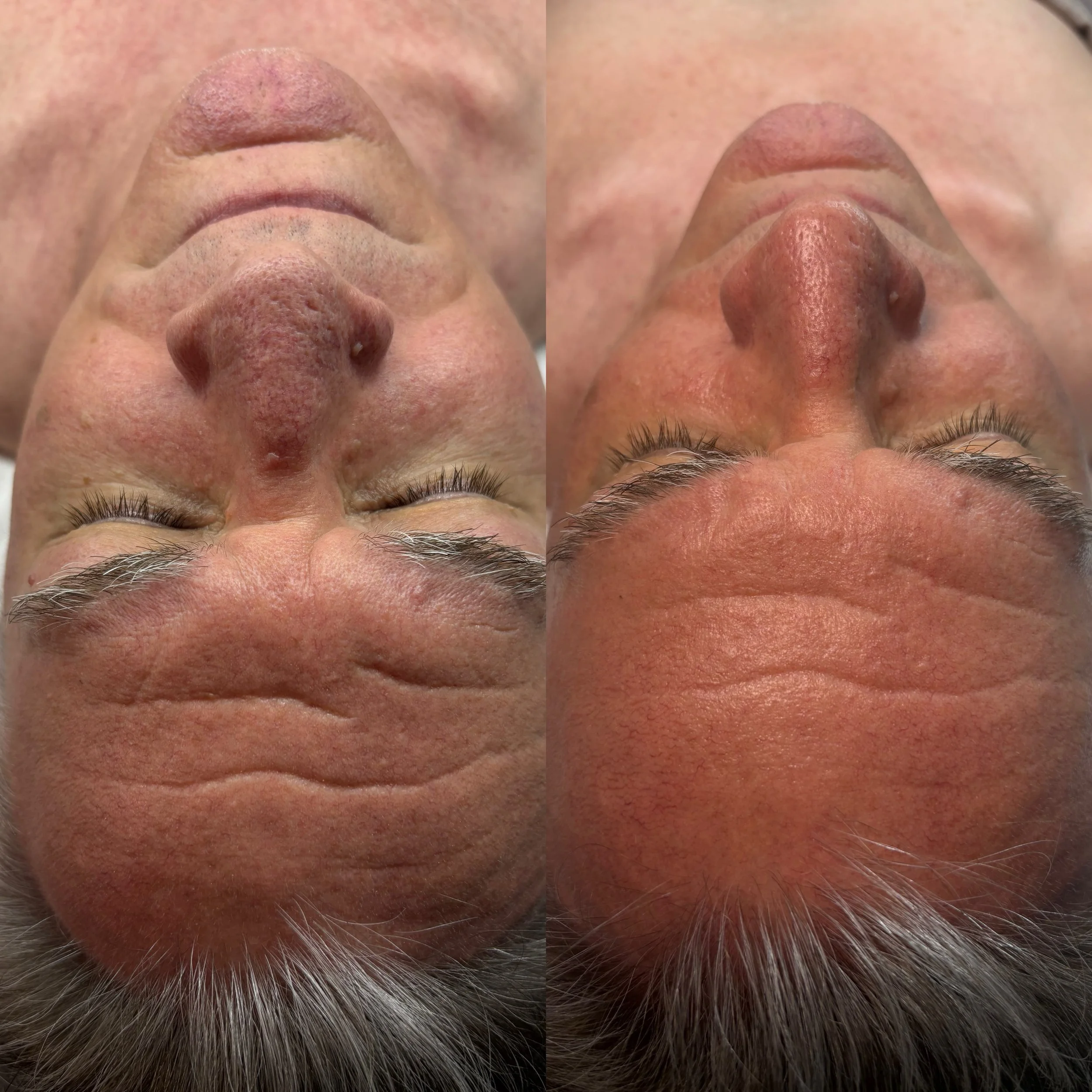 One of our best Microneedling transformations 💫

In 4 sessions we improved:

🪄Collagen and Elastin
🪄Skin texture
🪄Pore size

This treatment can be done year round with minimal downtime. 

Boost natural collagen and get smoother, firmer, healthier