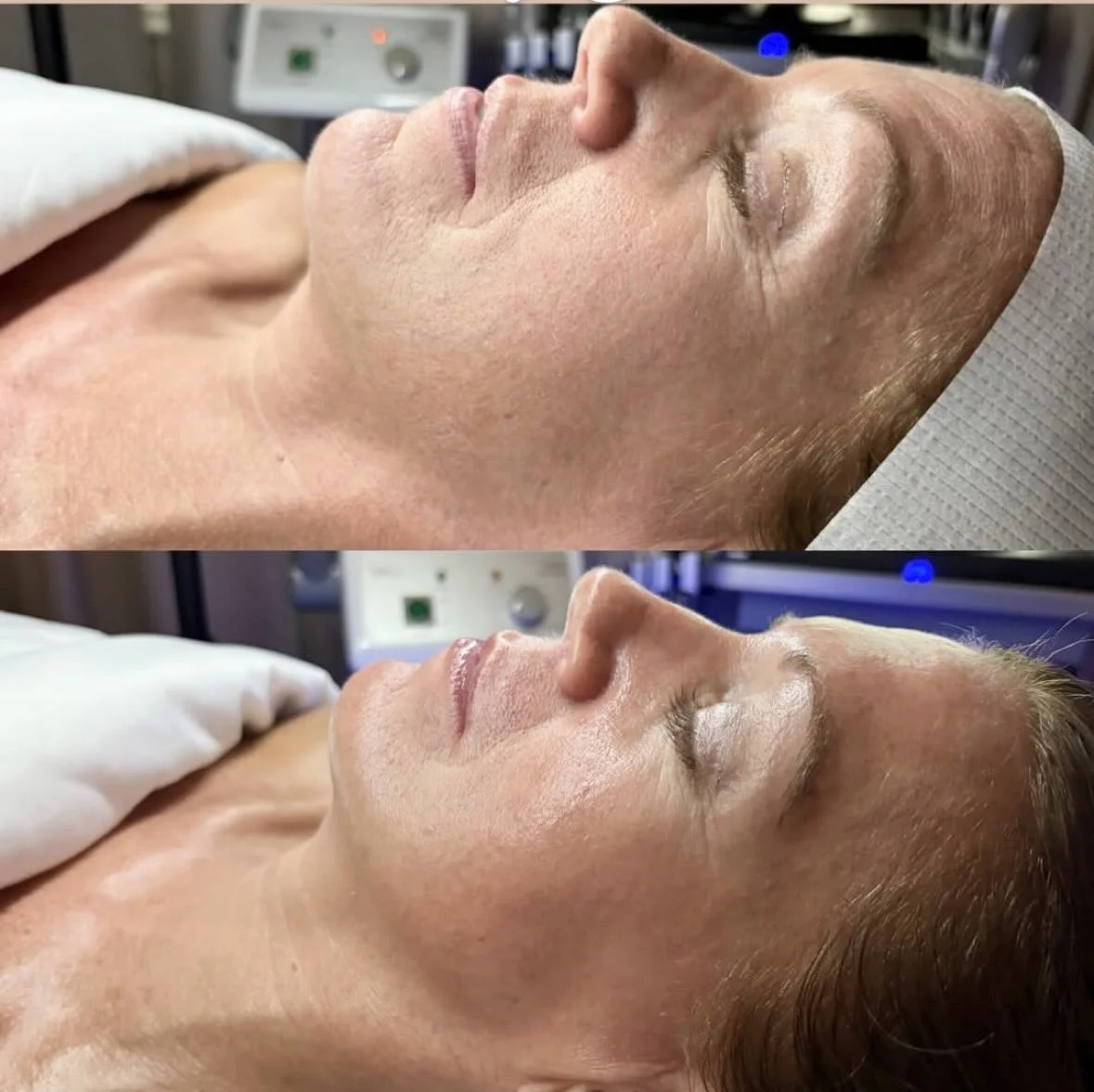 Before and after corrective facial Orlando — sculpting massage results at Silken Aesthetics