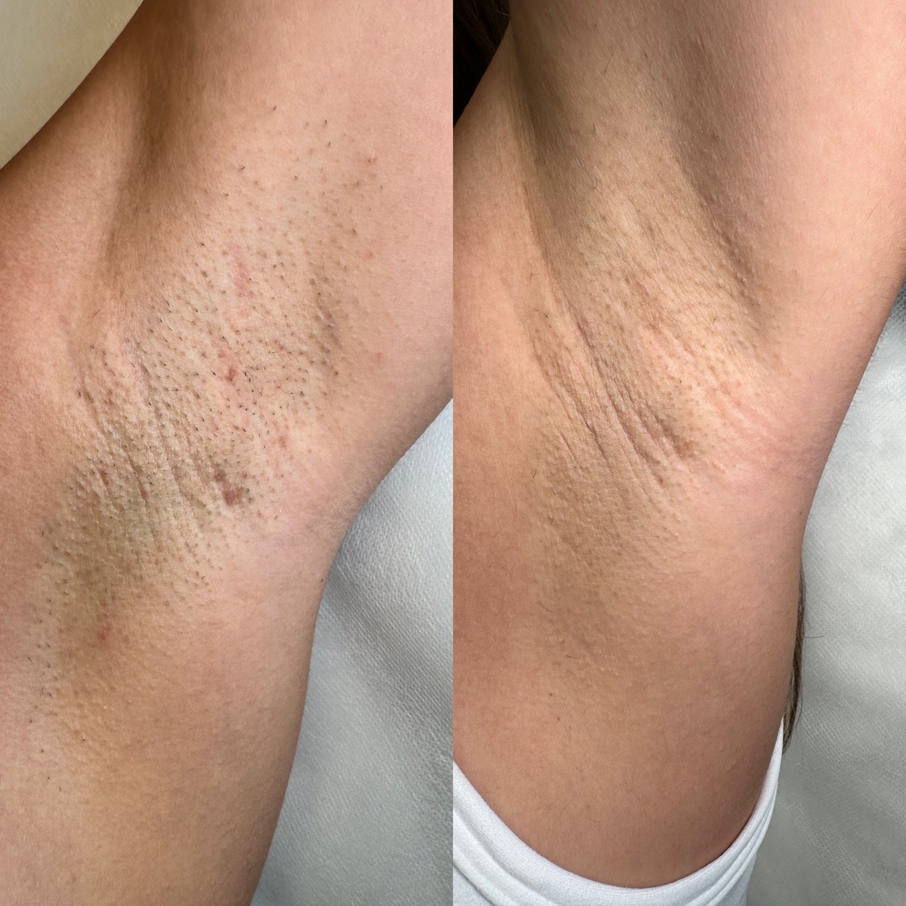 Laser hair removal before and after results after 1 session — Silken Aesthetics Downtown Orlando
