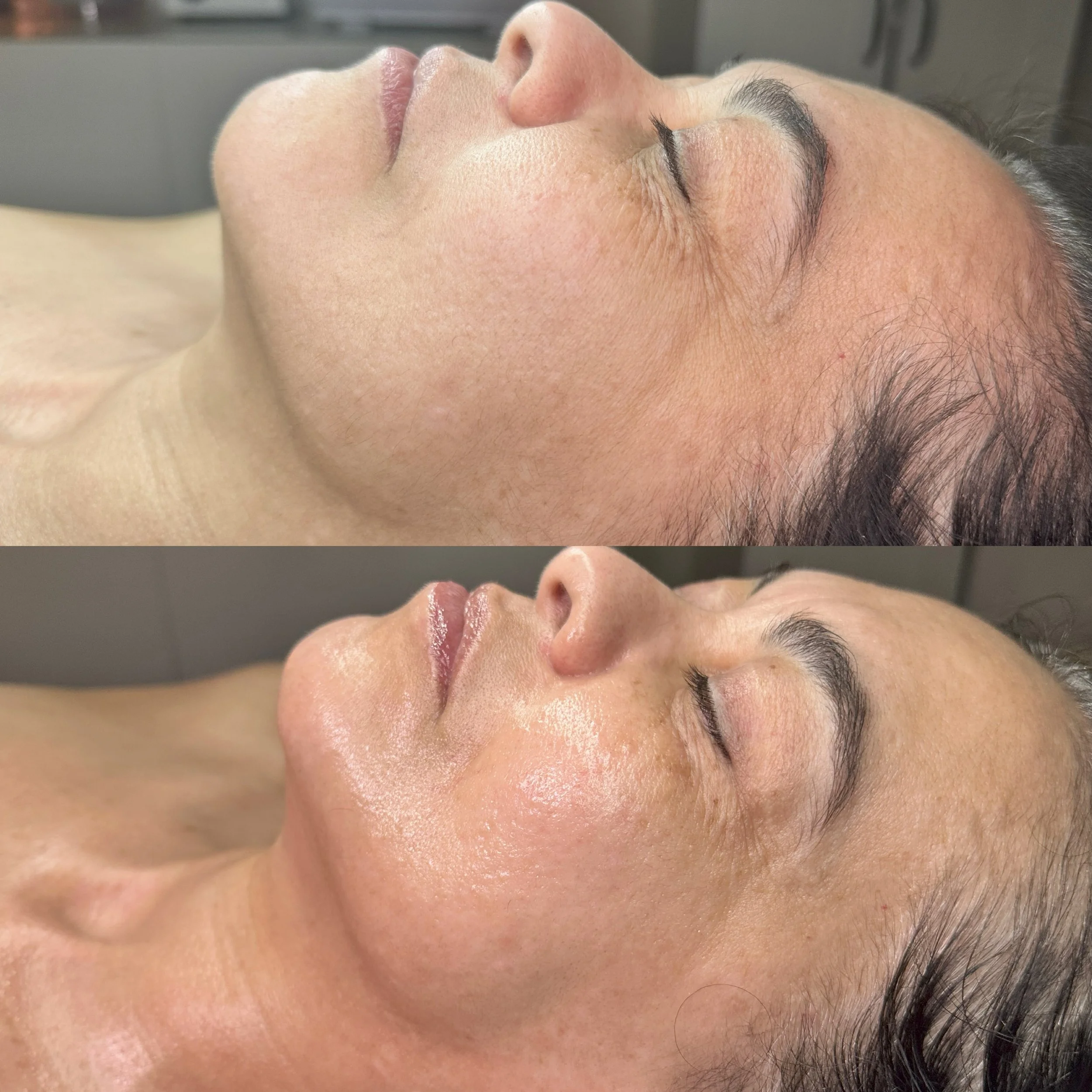 Before and after custom facial Orlando — Silken Aesthetics signature facial results