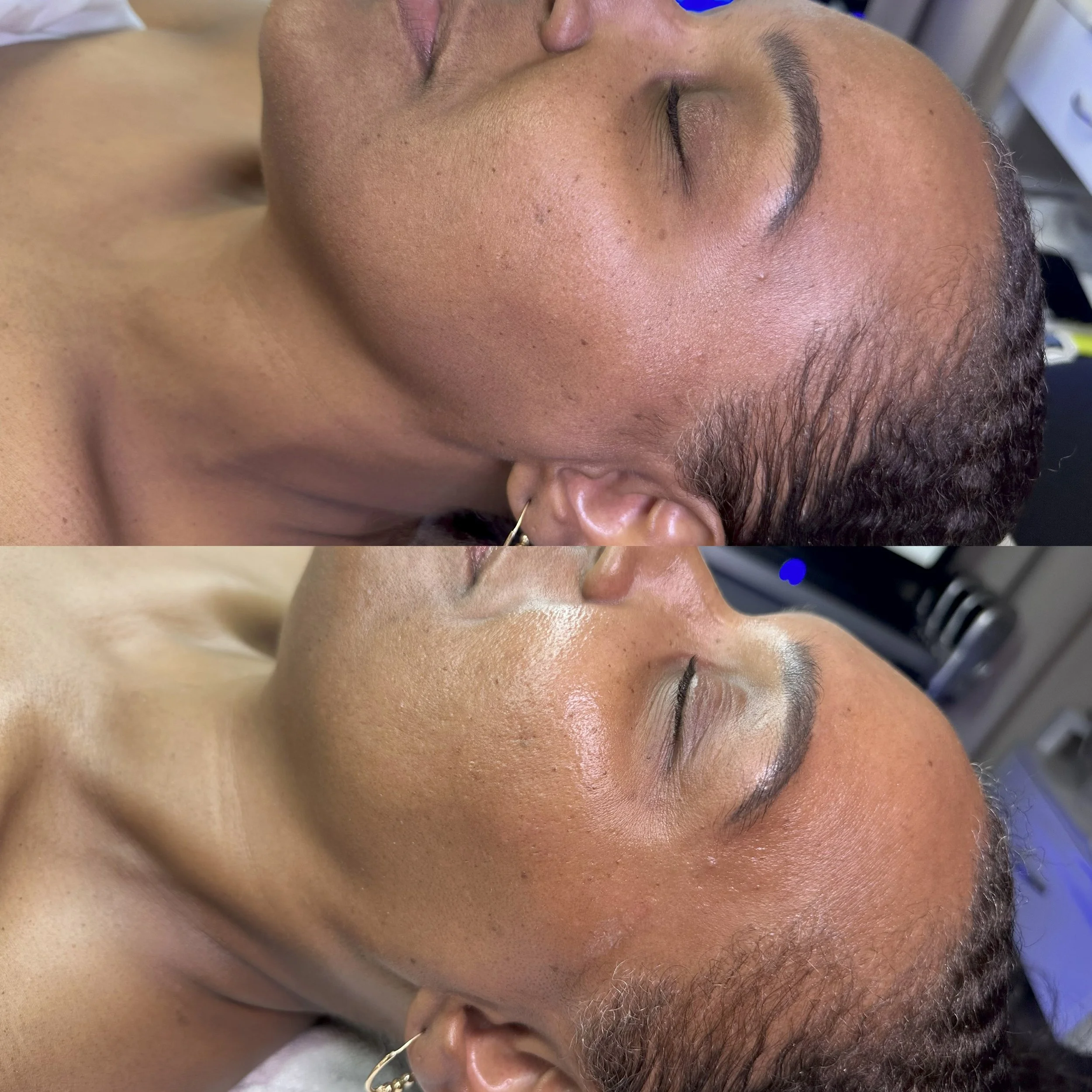 HydraFacial before and after Orlando — Platinum HydraFacial results at Silken Aesthetics