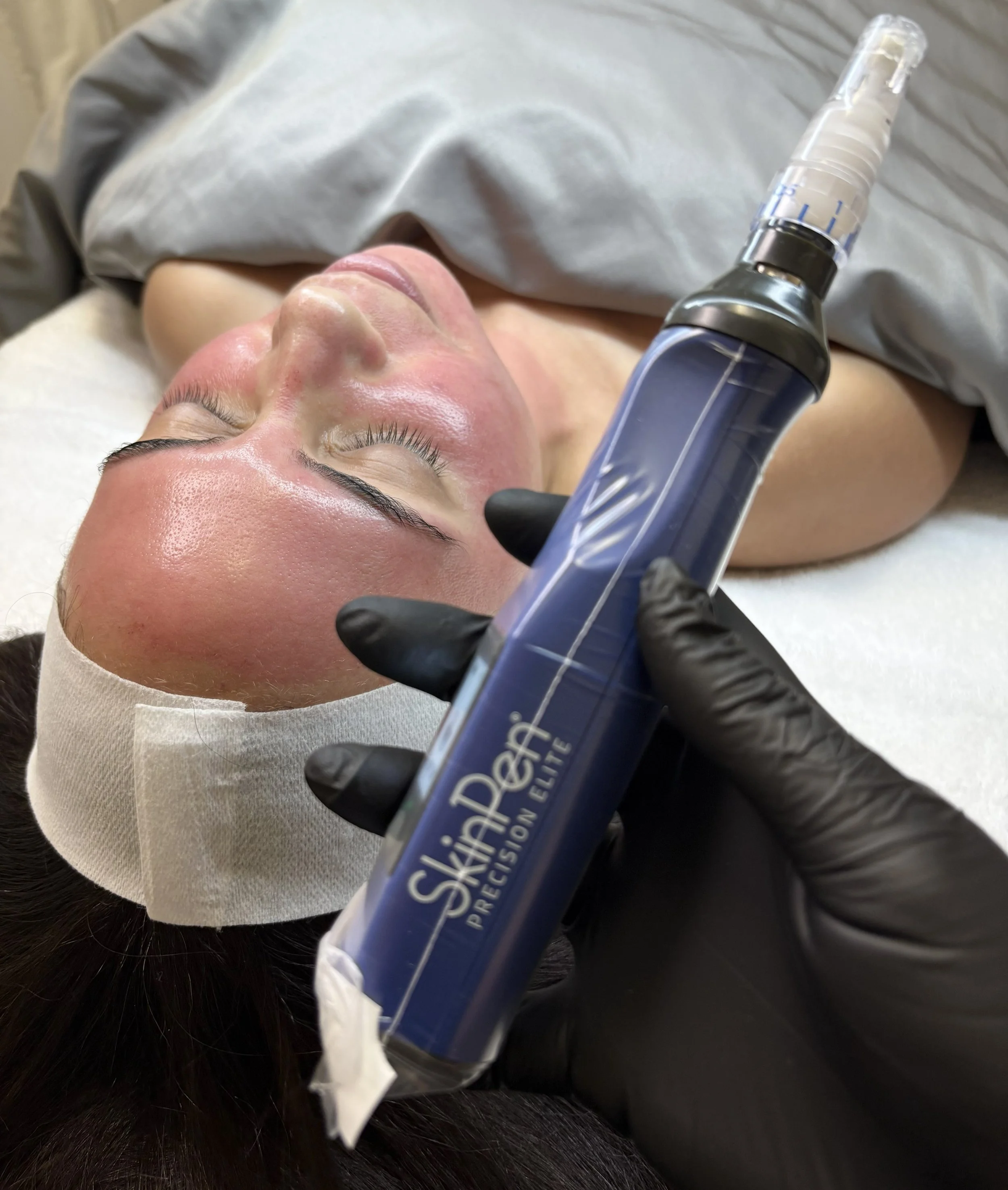 SkinPen Microneedling for texture and fine lines and acne scarring