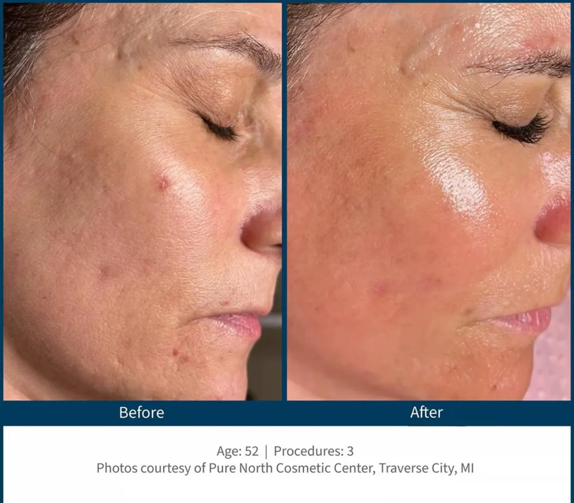 Microneedling before and after skin texture Orlando — SkinPen results at Silken Aesthetics Downtown Orlando