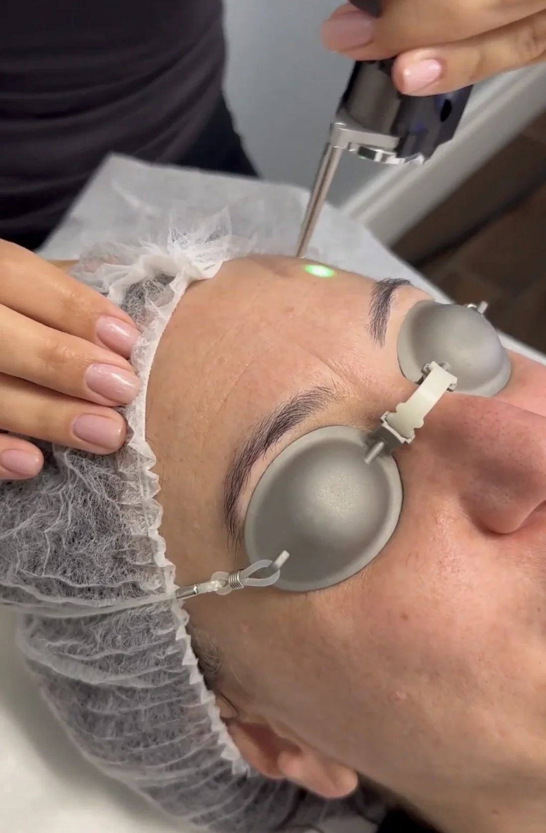 Person receiving a laser skincare treatment on their forehead while lying down with protective eye gear, a barrier cloth around their head, and a technician operating the device.