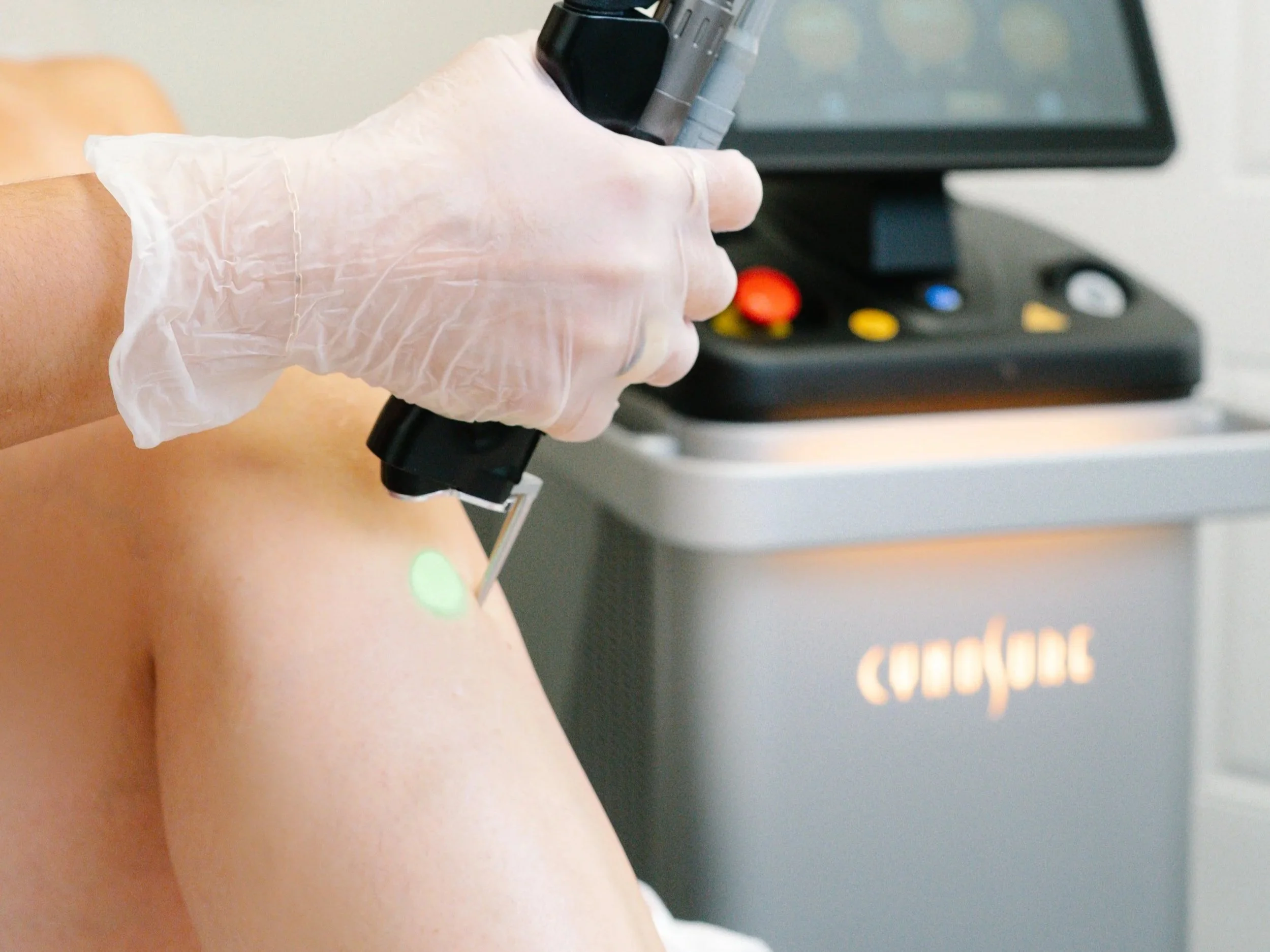laser hair removal on legs in orlando