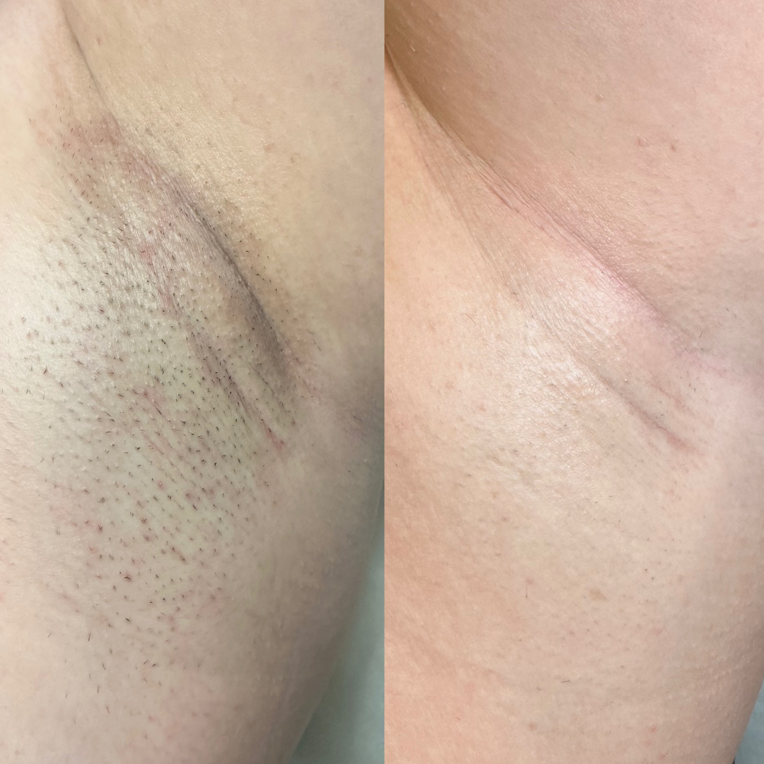 Underarm laser hair removal before and after 5 sessions — all skin tones — Silken Aesthetics Orlando FL