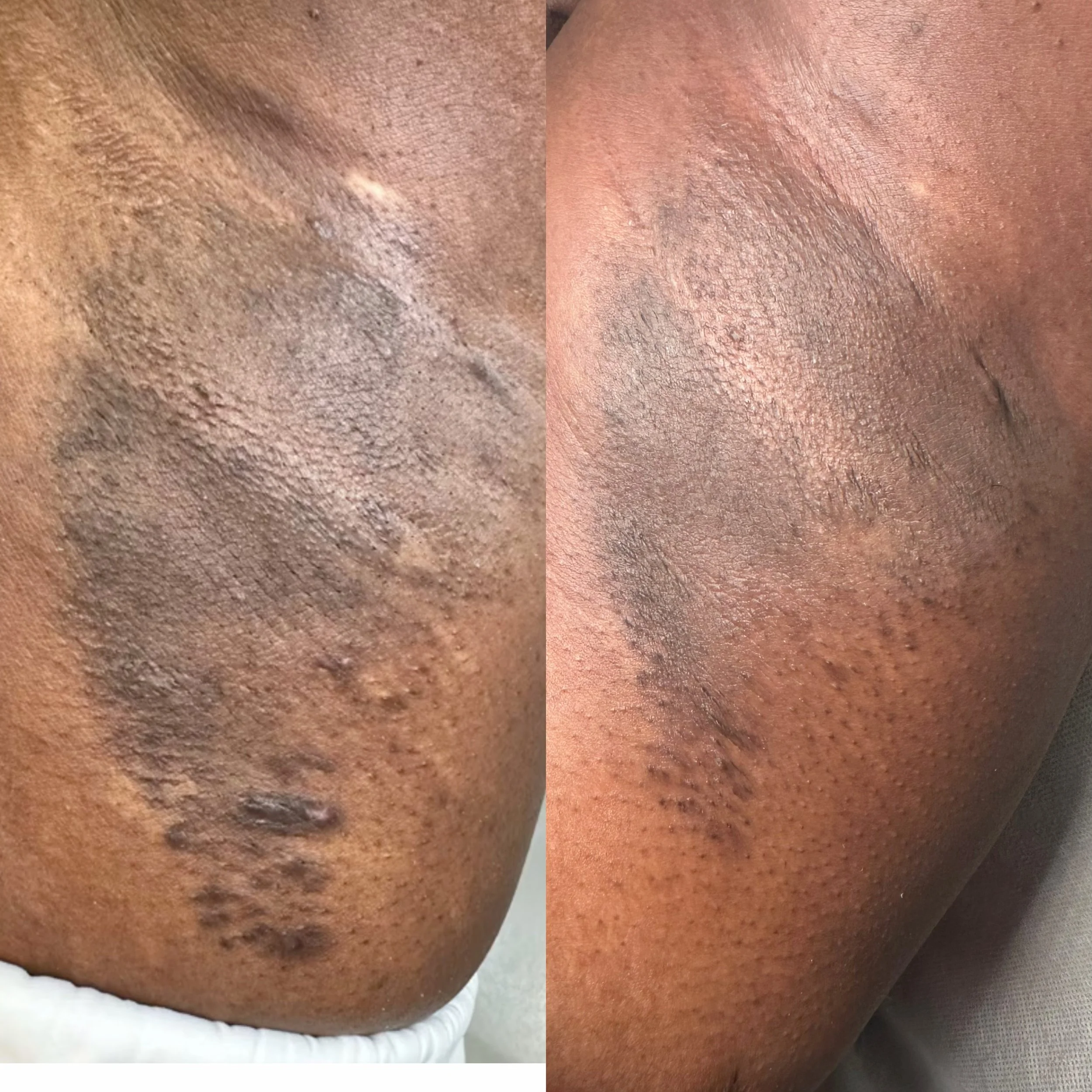 Laser hair removal before and after underarms — 4 sessions at Silken Aesthetics Orlando