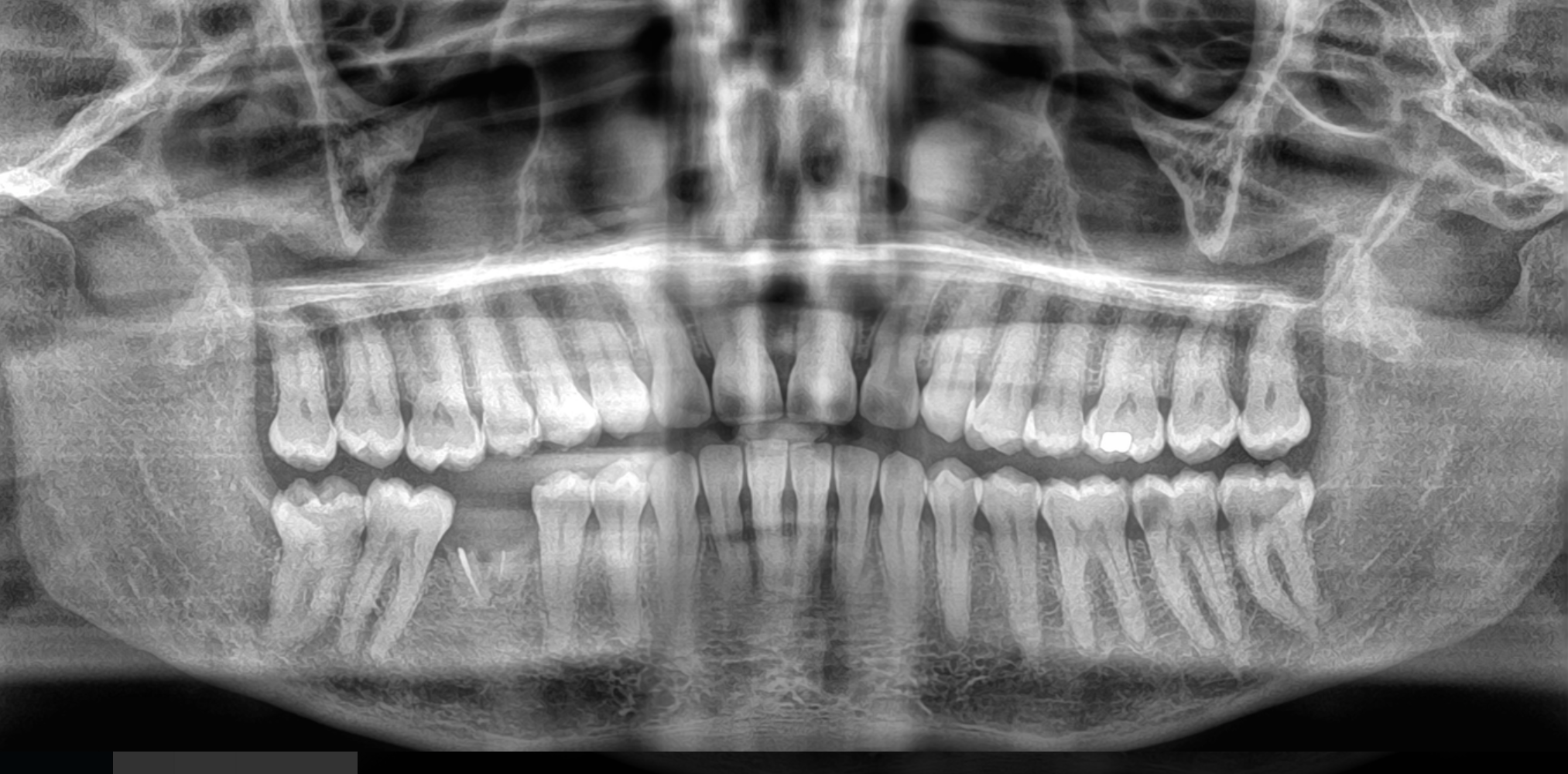 The image shows a panoramic dental X-ray of a person's mouth, including upper and lower teeth, jaws, and surrounding structures.