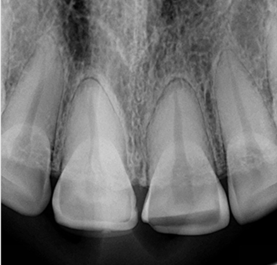 X-ray image of four front teeth showing dental structures and roots.
