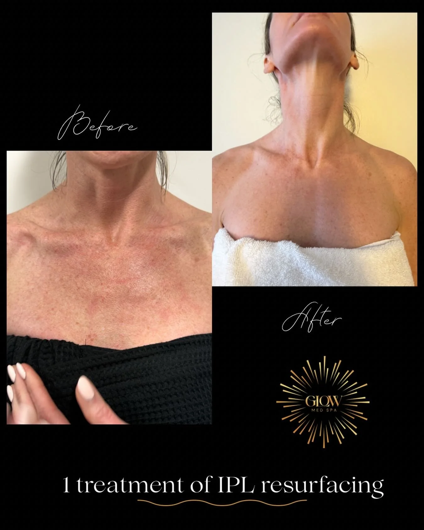 Sharing the amazing results of just one treatment of our IPL laser!! We already are noticing tighter, smoother, brighter skin in her face and neck area. INCREDIBLE!