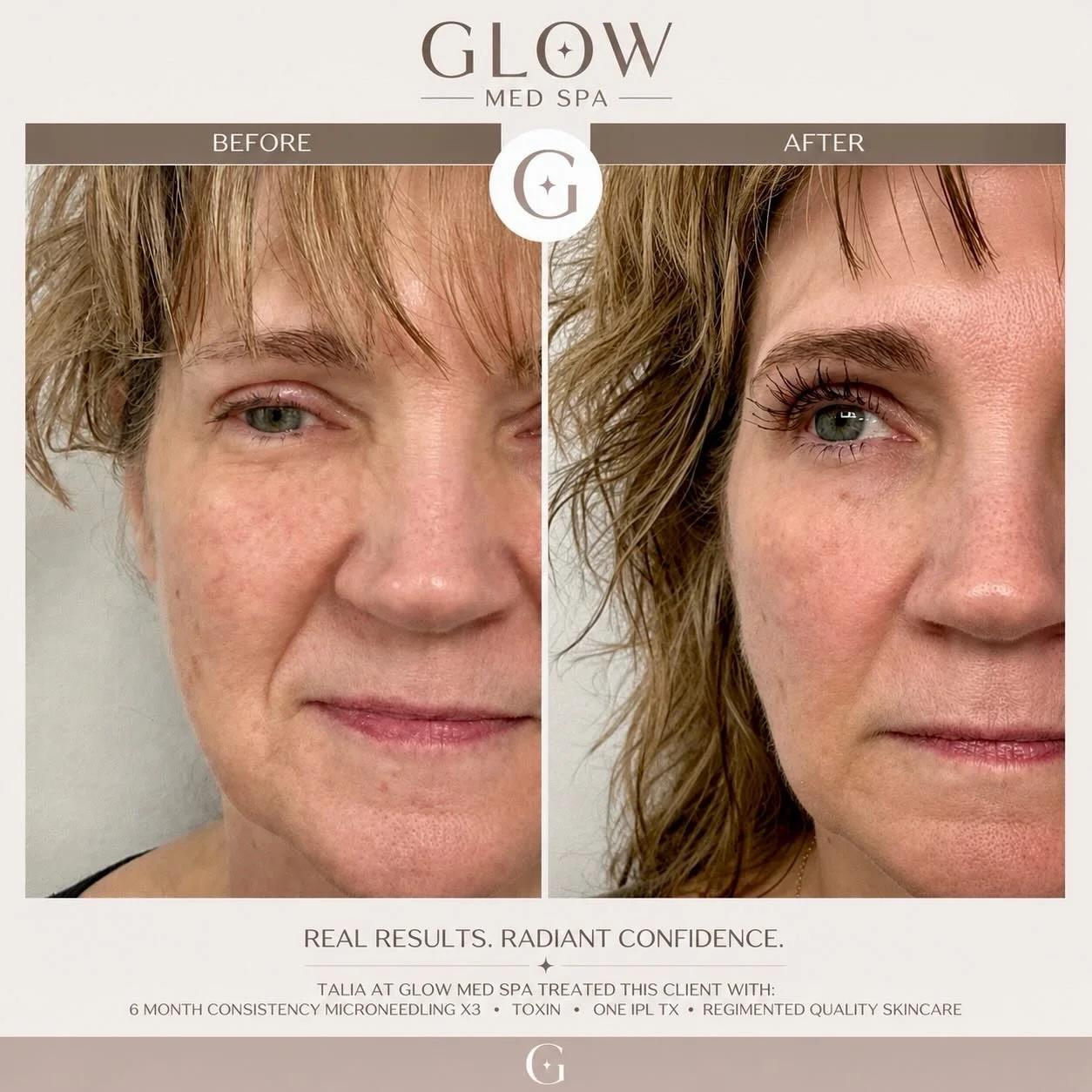 ✨ Real Results Through Consistency ✨

Beautiful skin isn&rsquo;t created overnight. It&rsquo;s built through a customized treatment plan, quality skincare, and CONSISTENCY.

Over the course of 6 months, Talia at Glow Med Spa helped this client achiev