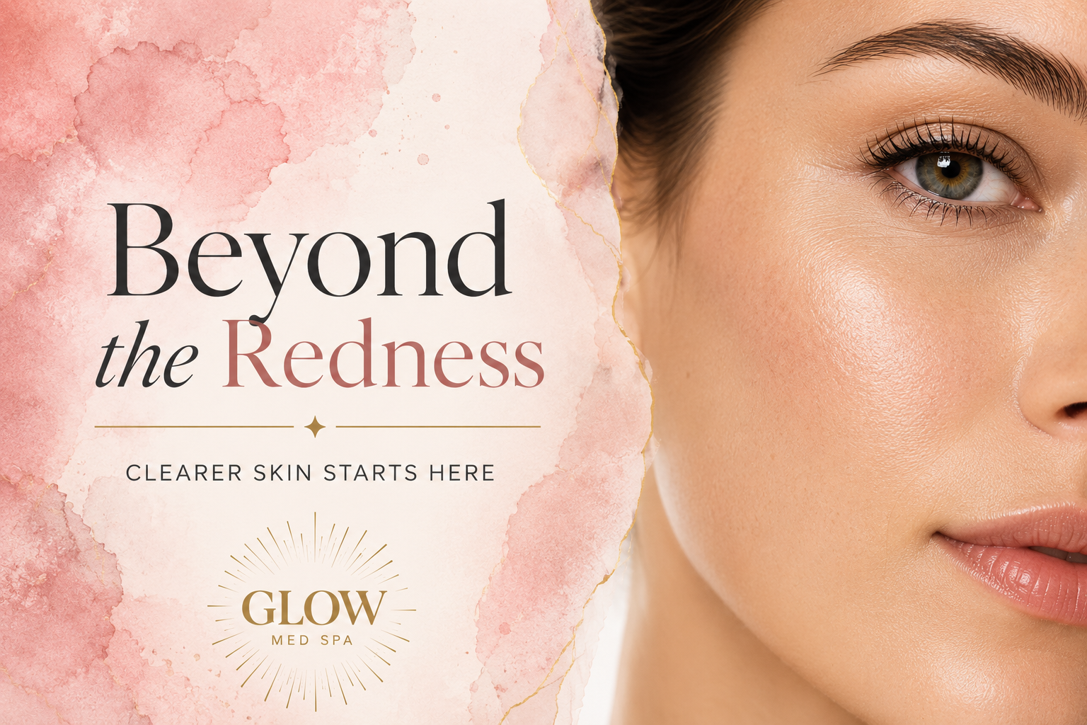 Why Summer Is the Perfect Time to Treat Facial Veins and Redness