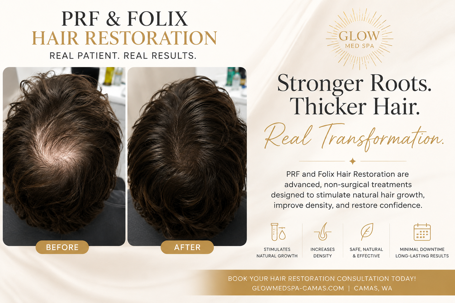 PRF vs. Folix Hair Restoration: Which Hair Loss Treatment Is Right for You?