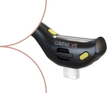 XPL-IPL laser treatment for sun damage and pigmentation at Glow Medspa Camas WA