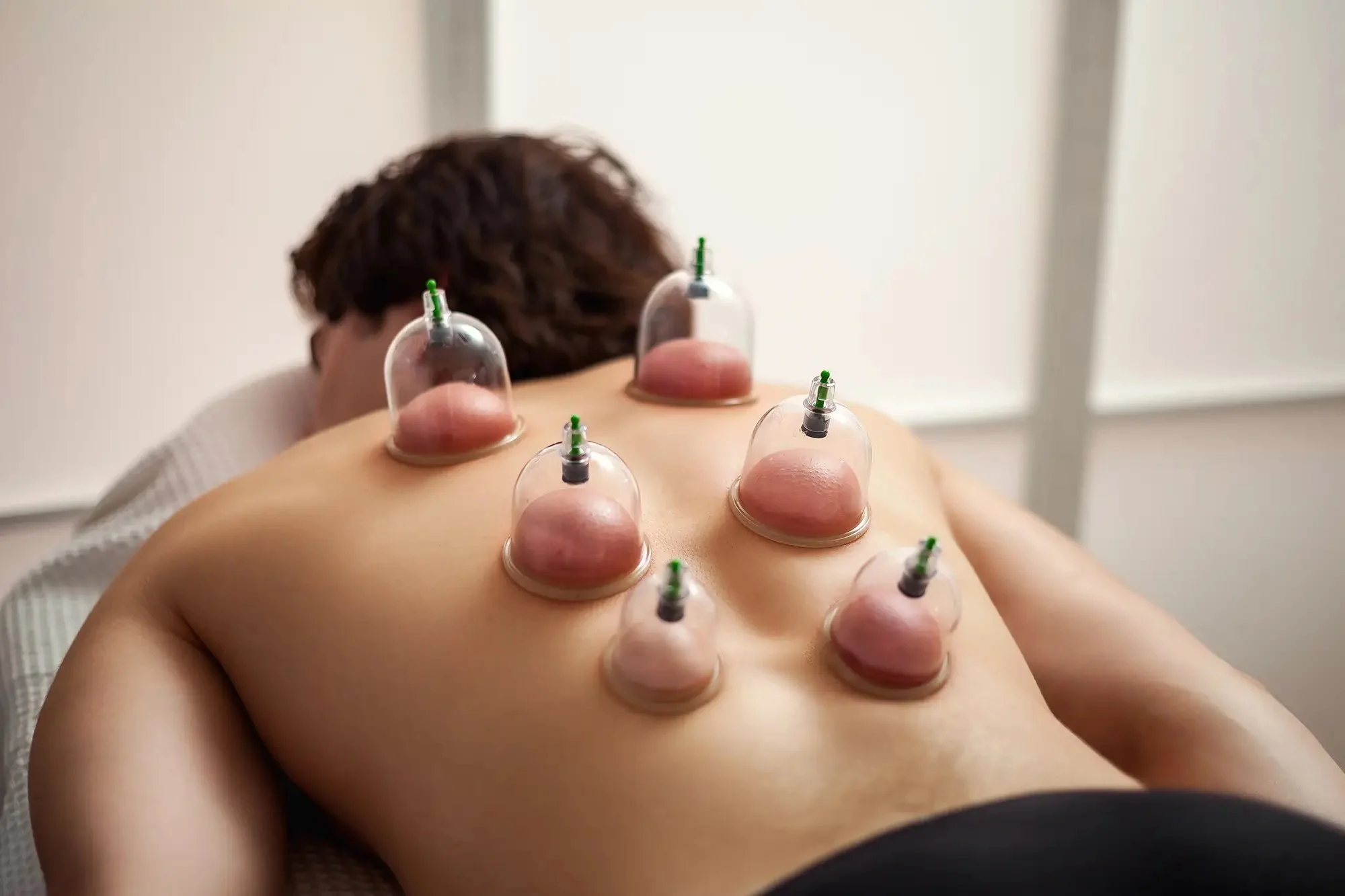 Person receiving cupping therapy with multiple small glass cups applied to their back.