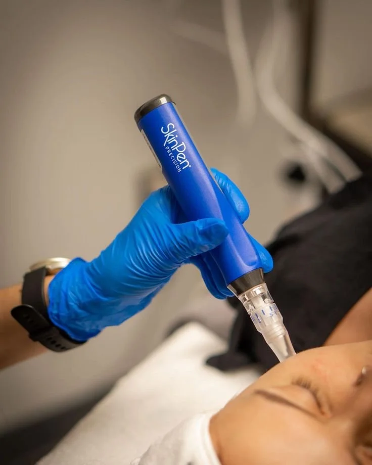 Microneedling for Acne Scars: How It Improves Skin Texture