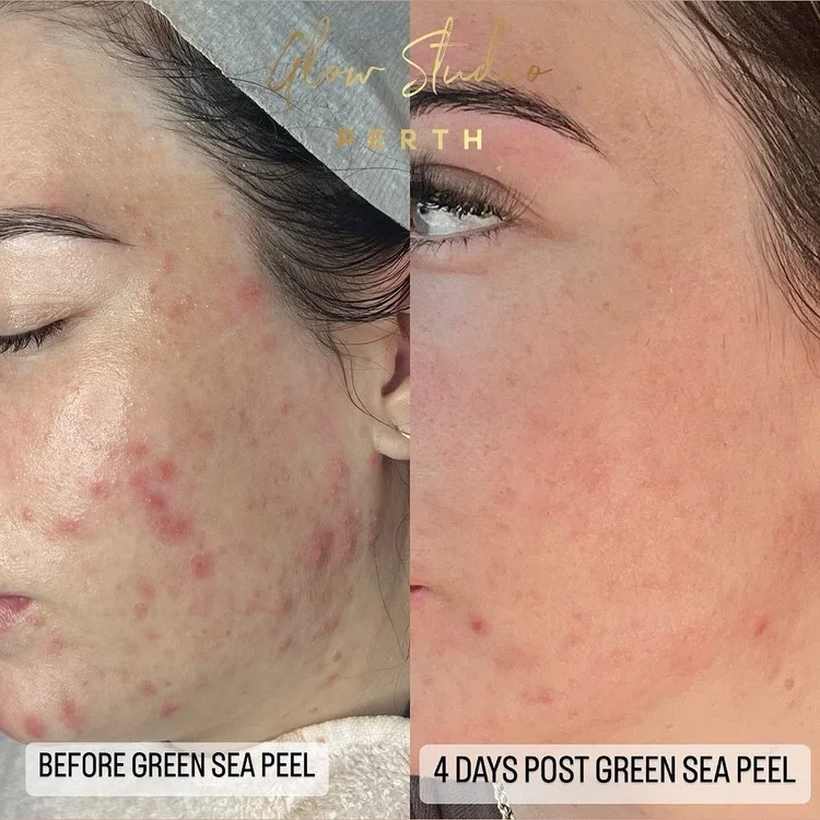 The Green Sea Peel at Lindsey Rapp Skin Waterford Michigan