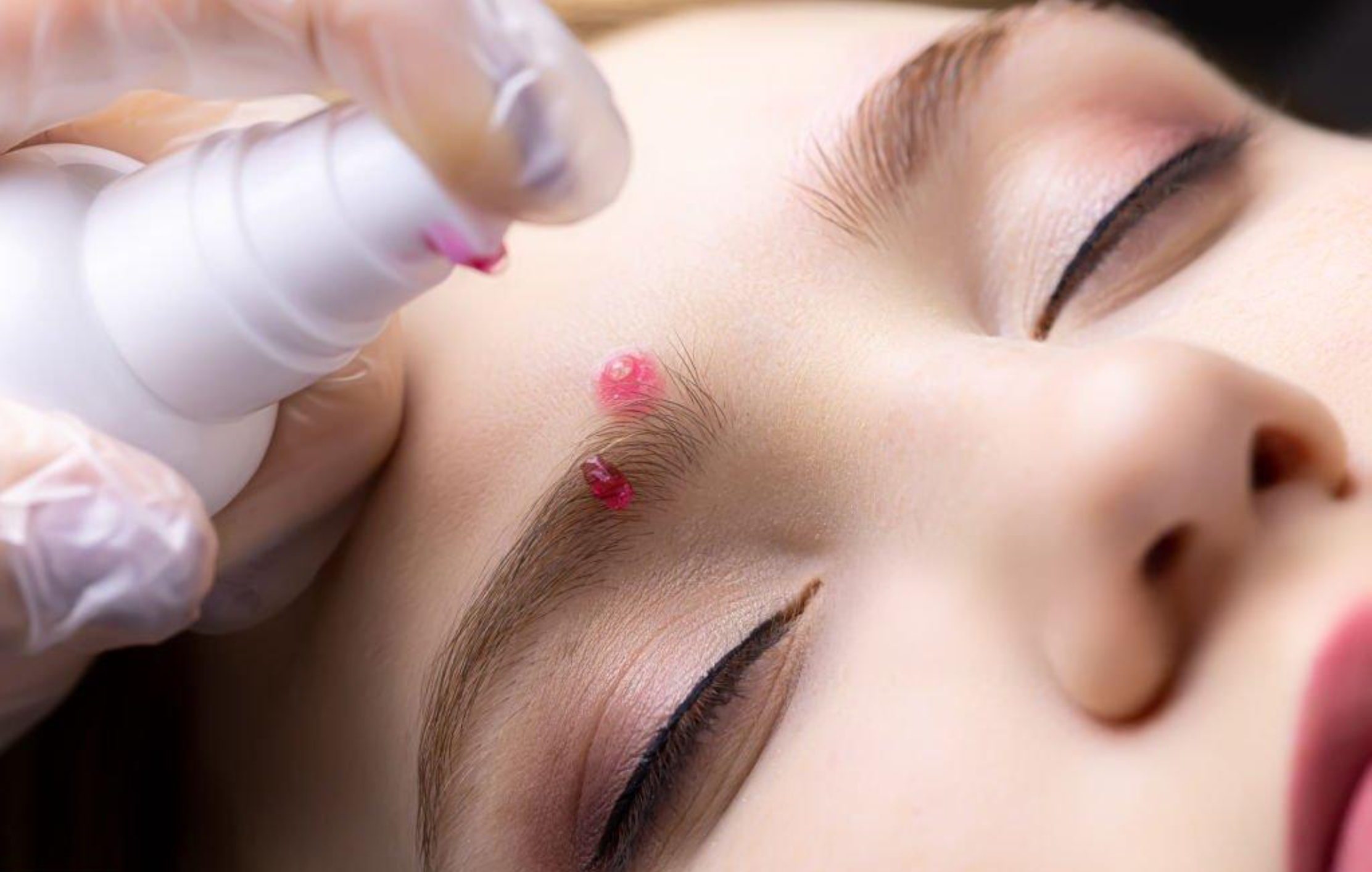Close-up of a woman with her eyes closed, receiving a cosmetic procedure on her eyebrow with a small tool, with visible signs of a recent skin treatment or infection near her eye.