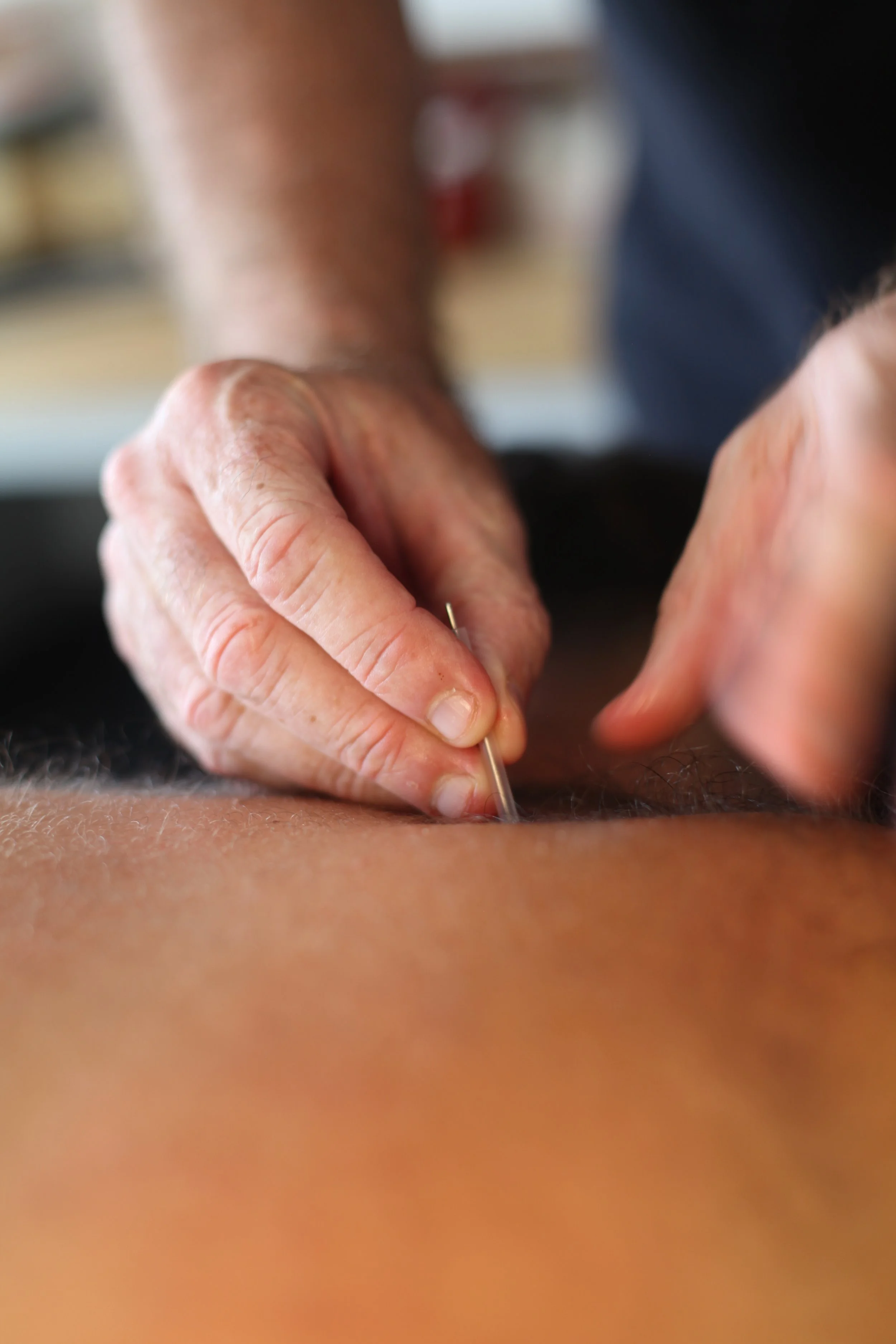 Acupuncture in Bondi Junction: The Science-Backed Benefits & How It Really Works