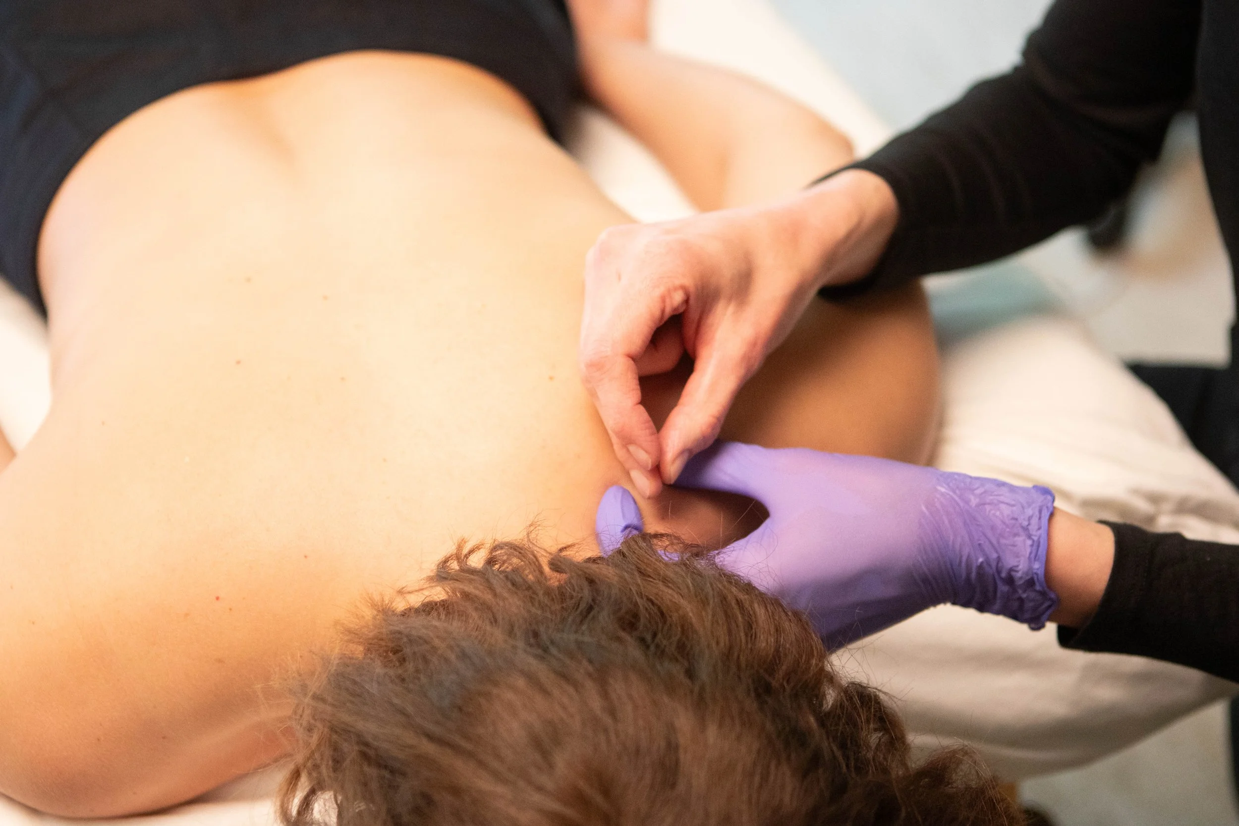 Dry needling can help relax muscle tension, reduce discomfort, and restore healthy mobility and function.