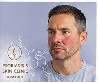 Man with rosacea illustrating the possible connection between stress and skin flushing