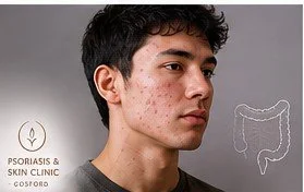 Teenage boy with acne illustrating the possible connection between gut dysbiosis and skin health