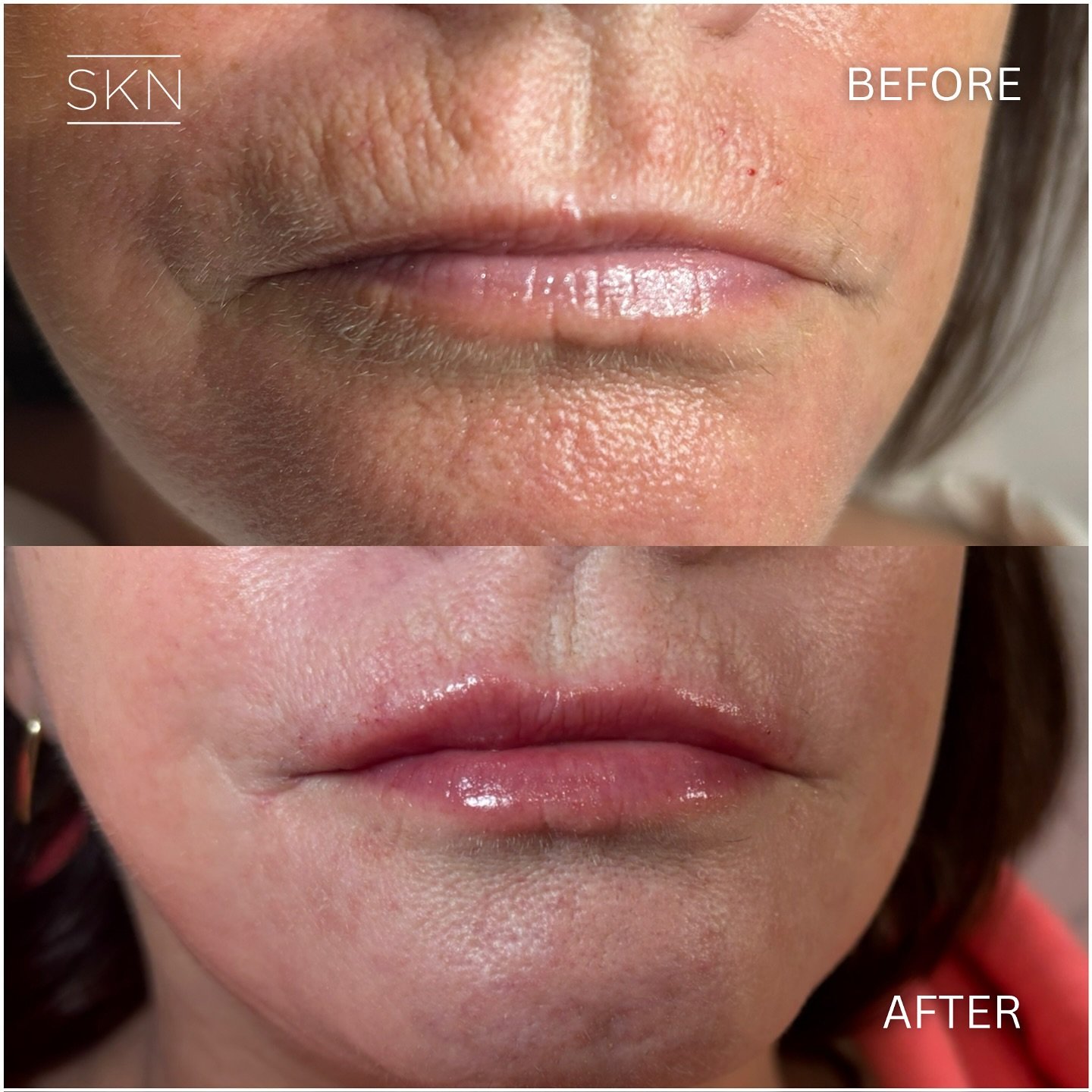 A bespoke treatment plan to target peri oral ageing, smokers lines and downturn smile. This is often seen with loss of collagen and elastin as we age.

To book in DM us or contact the clinic today.
The SKN Nurse 
0161 546 4622
www.thesknnurse.co.uk
i