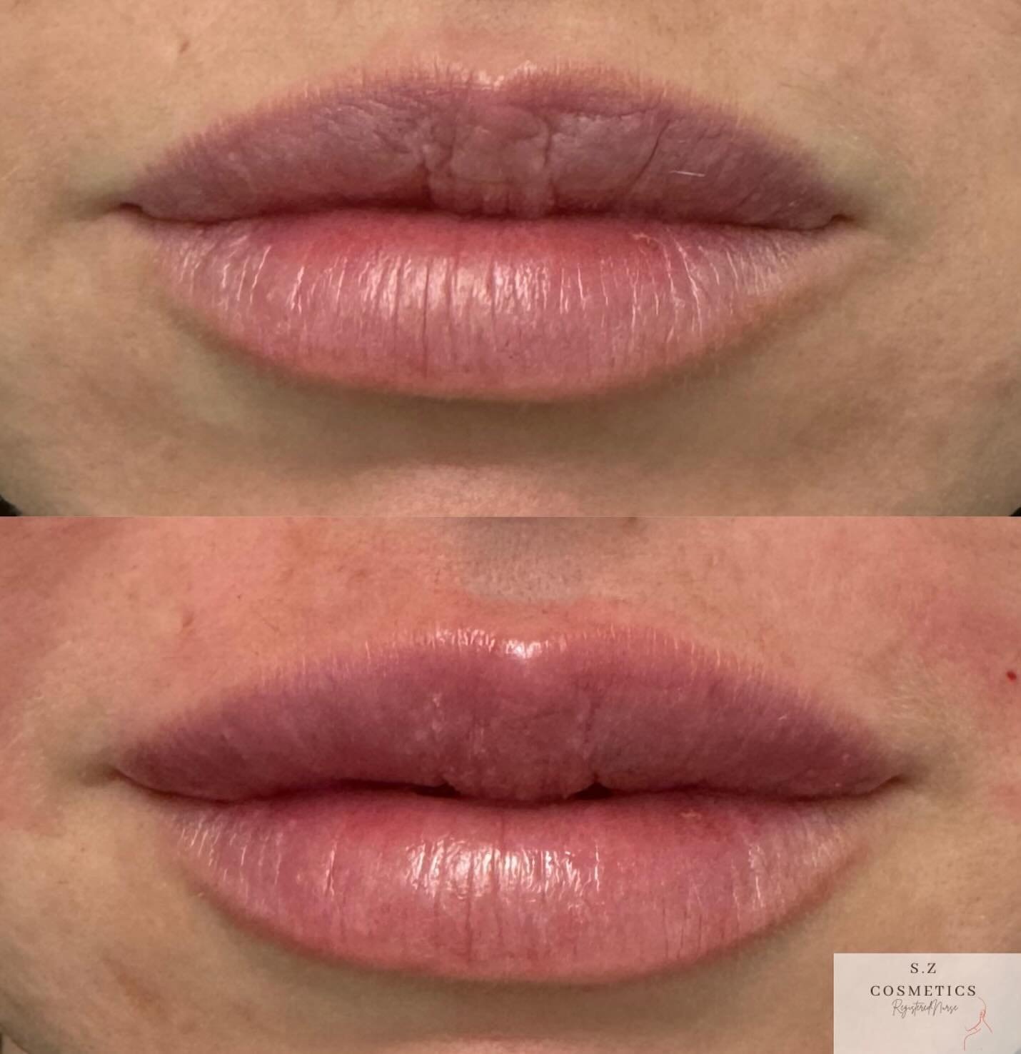 Before and after: precise placement for a balanced, fuller appearance. 

Patient-centered results are my priority at SZ Cosmetics 🤍

Dm to book in for a free consult or please use link in bio🤎✨ 

Results vary per individual