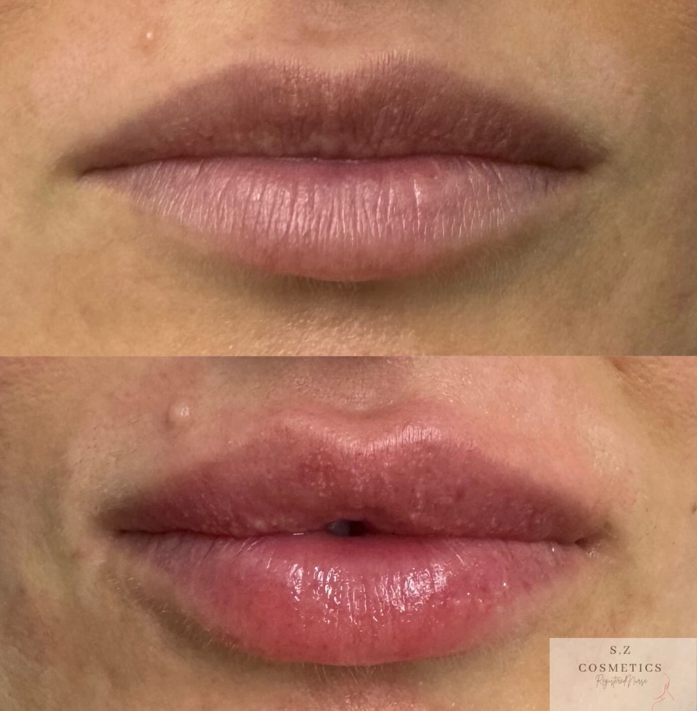 Enhance your natural beauty with perfectly balanced lips 💋✨ Whether you&rsquo;re looking for a subtle boost or more defined volume, we customize every treatment to your unique features. Let&rsquo;s create a look you&rsquo;ll love! 💉 

Free consulta