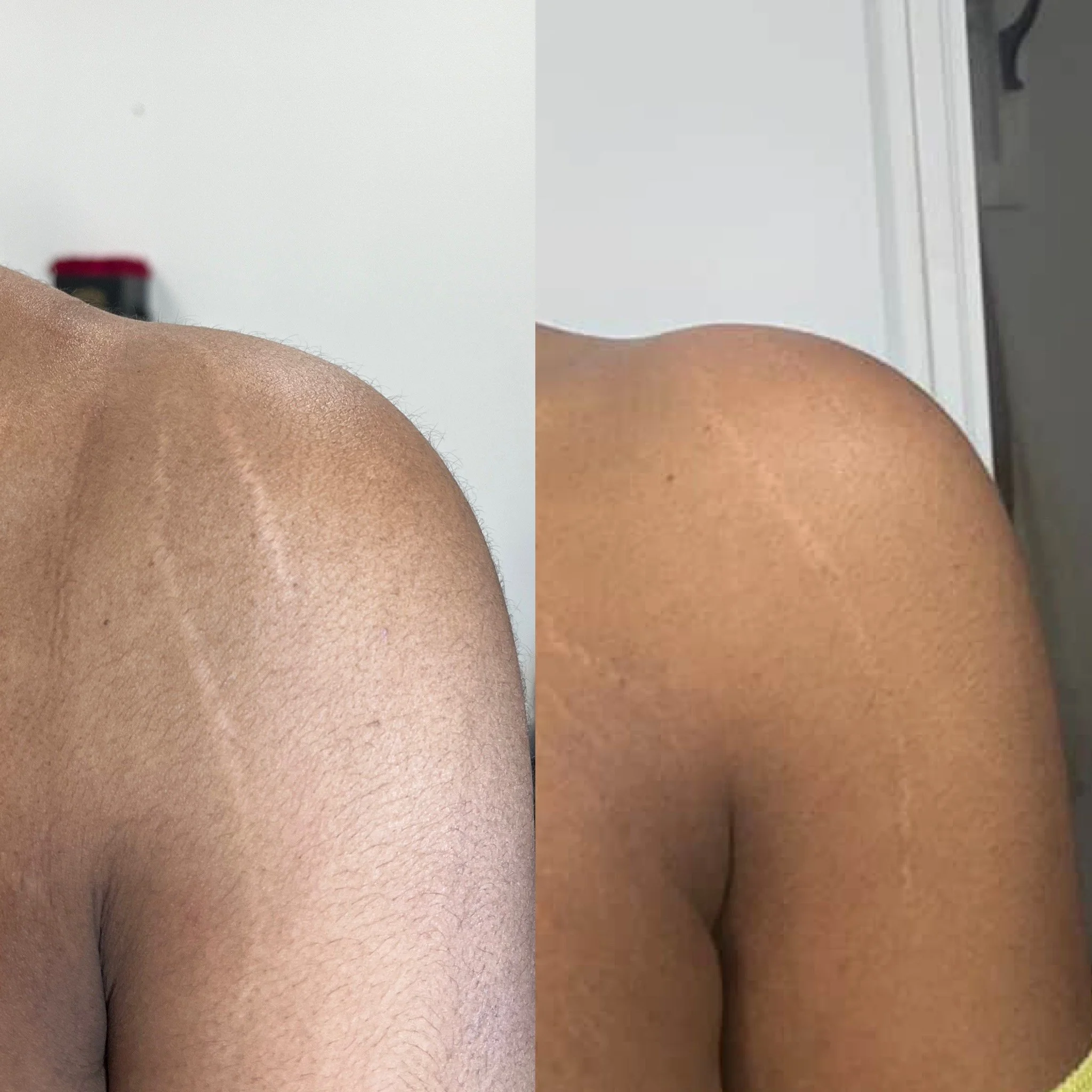 Comparison of two close-up views of a person's shoulder and upper back, showing skin texture and tone, with the left side more prominent and the right side partially visible.