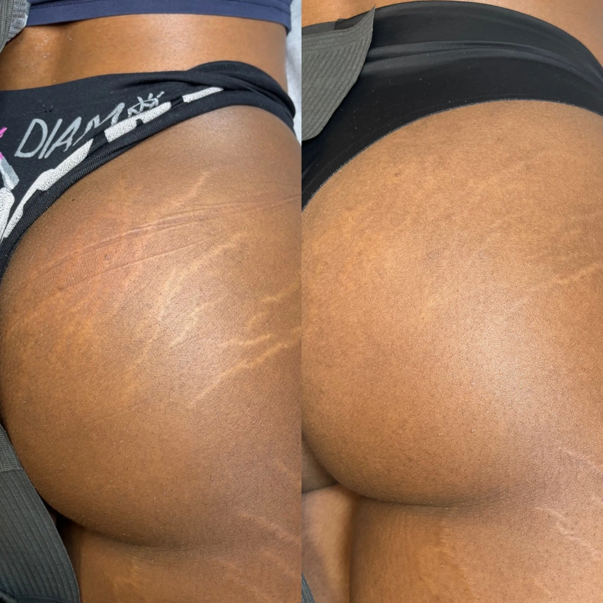 Close-up of a person's buttocks, showing a before and after comparison of skin with and without stretch marks, wearing black and blue athletic shorts.