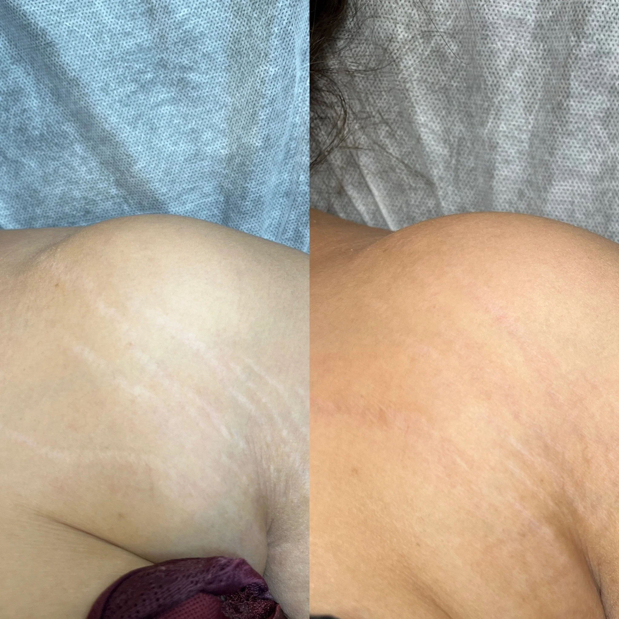 Comparison of skin on two different elbows, one with scars or marks and the other smooth, with gray fabric background.