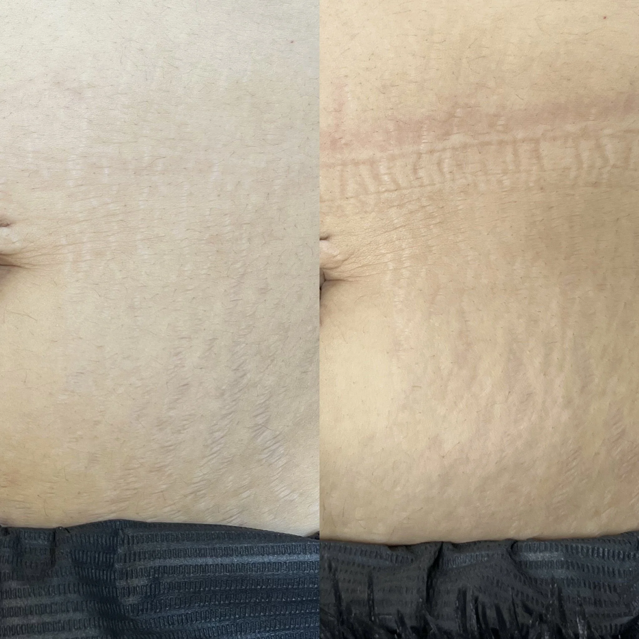Comparison of skin texture, showing before and after skincare treatment, with visible reduction in skin dryness and improved texture on the right side.