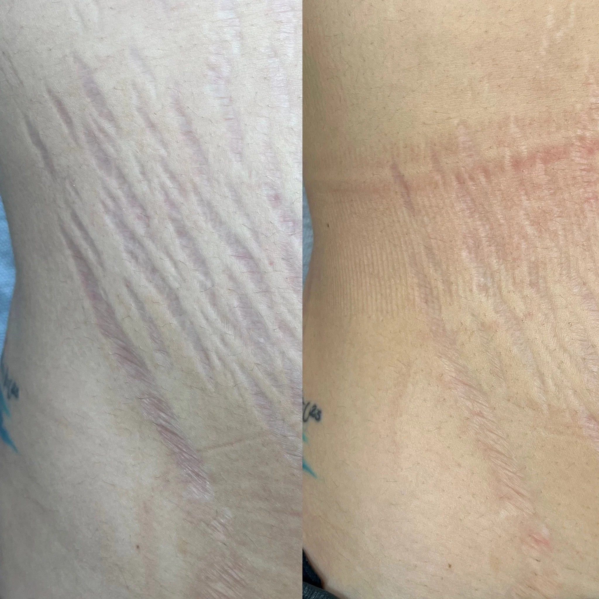 Comparison of skin with stretch marks before and after treatment, showing significant reduction in the appearance of stretch marks.