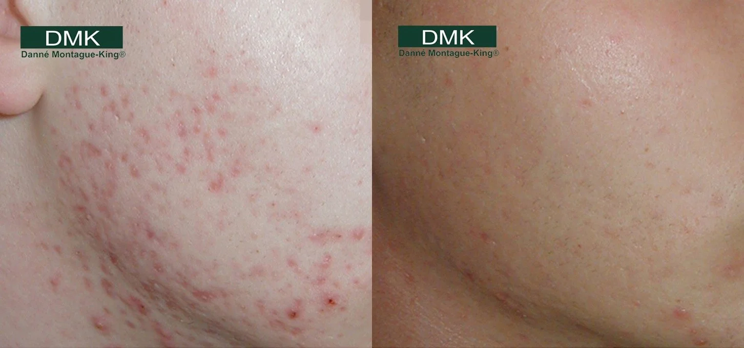 DMK acne before/after