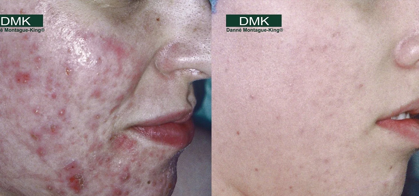 DMK Acne Before/after 