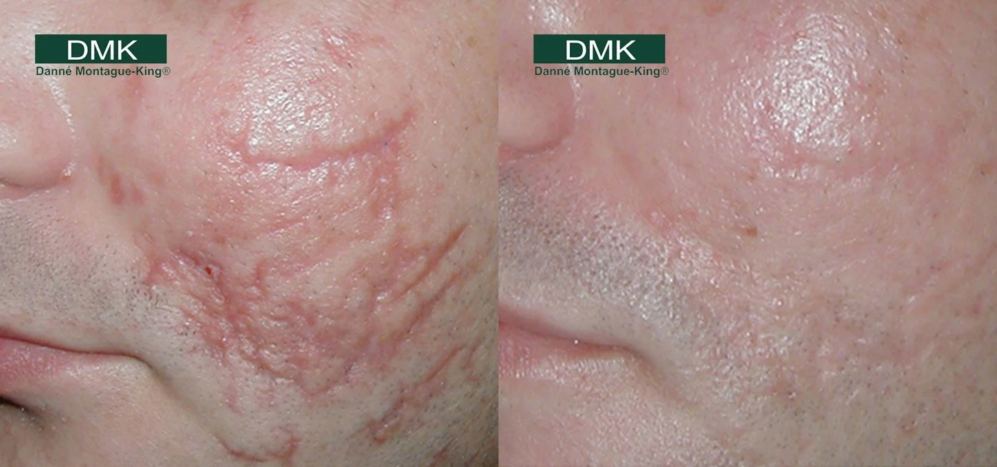 DMK Scarring before/After 
