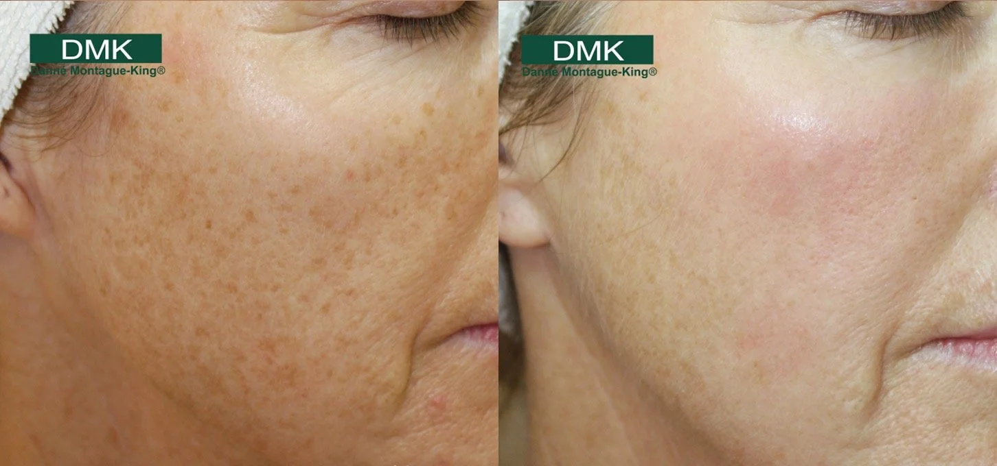 DMK pigmentation before/after 