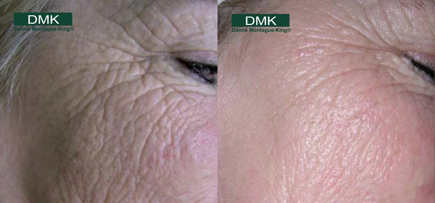 DMK wrinkles before/after