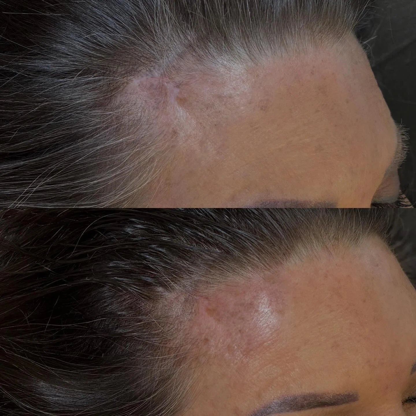 Facelift scar camouflage with a touch of SMP (scalp micro pigmentation) 
Though smp usually is to fill in your hairline or add density in your part or even all over - it was a great addition for this first session of scar camouflage. 
I love being ab