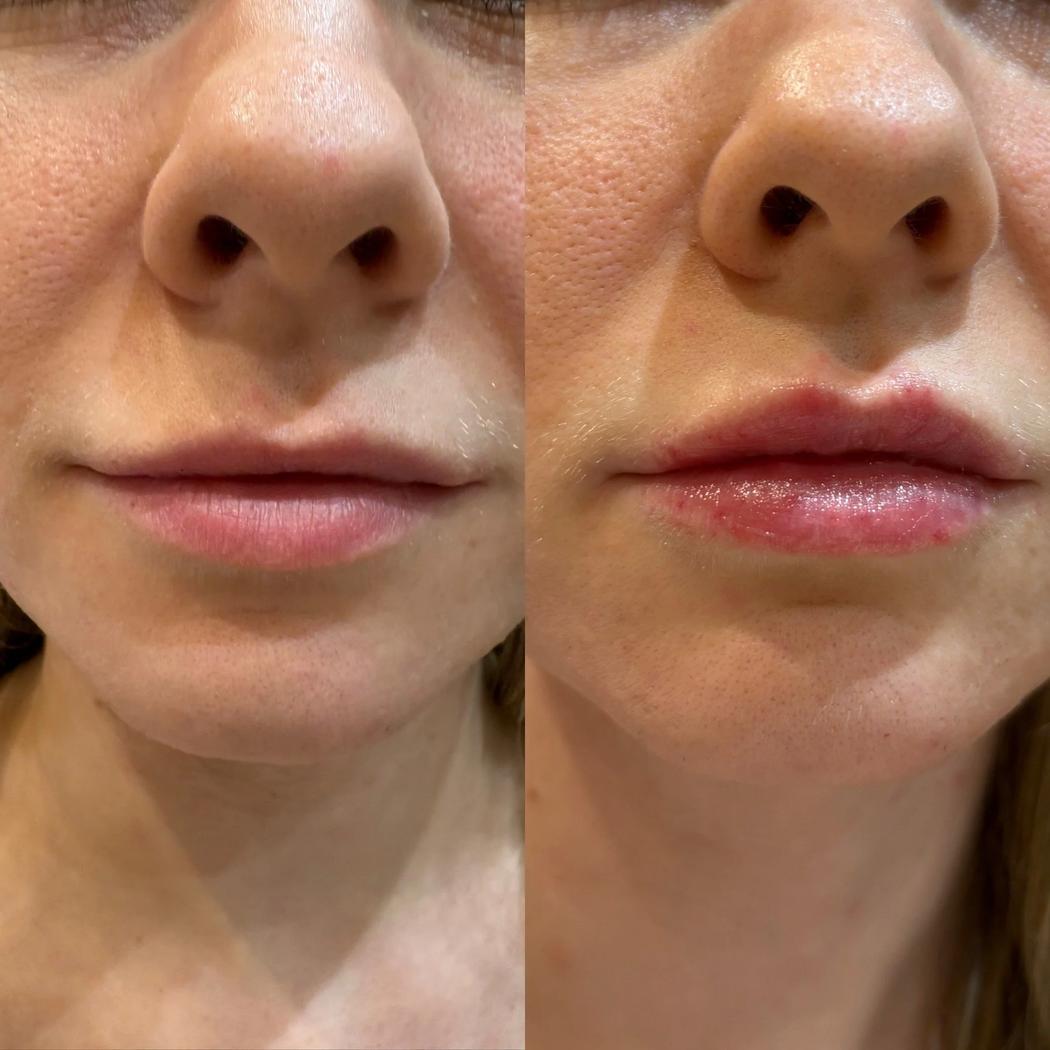 Close-up of a woman's face showing before and after images of lip enhancement, with the right side showing plumper, more defined lips.