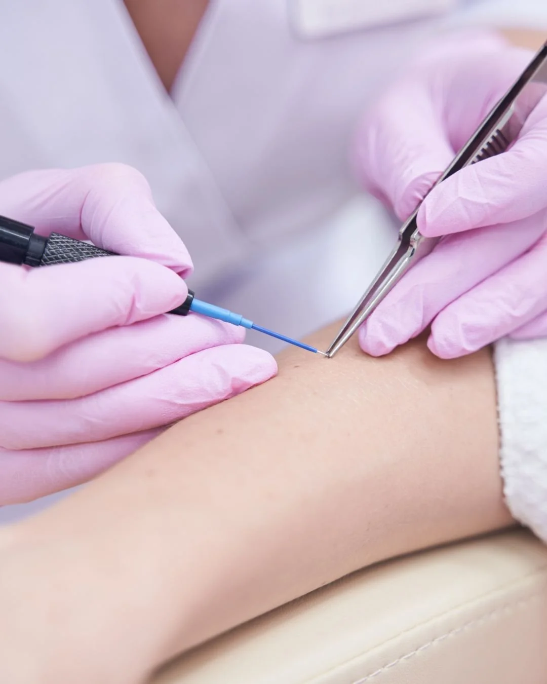 Facial &amp; Chest Thread Veins: Causes, Concerns &amp; Safe Doctor-Led Treatment with Advanced Electrocautery in Hale, Cheshire