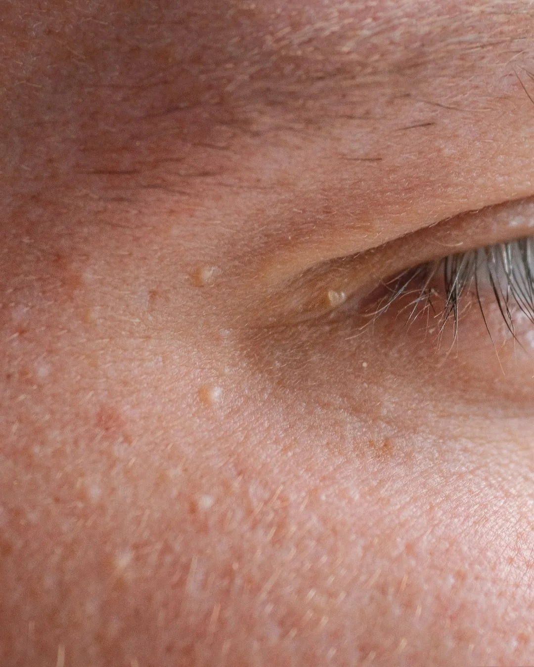 Milia: What They Are, Why They Appear &amp; Safe Doctor-Led Removal with Advanced Electrocautery in Hale, Cheshire