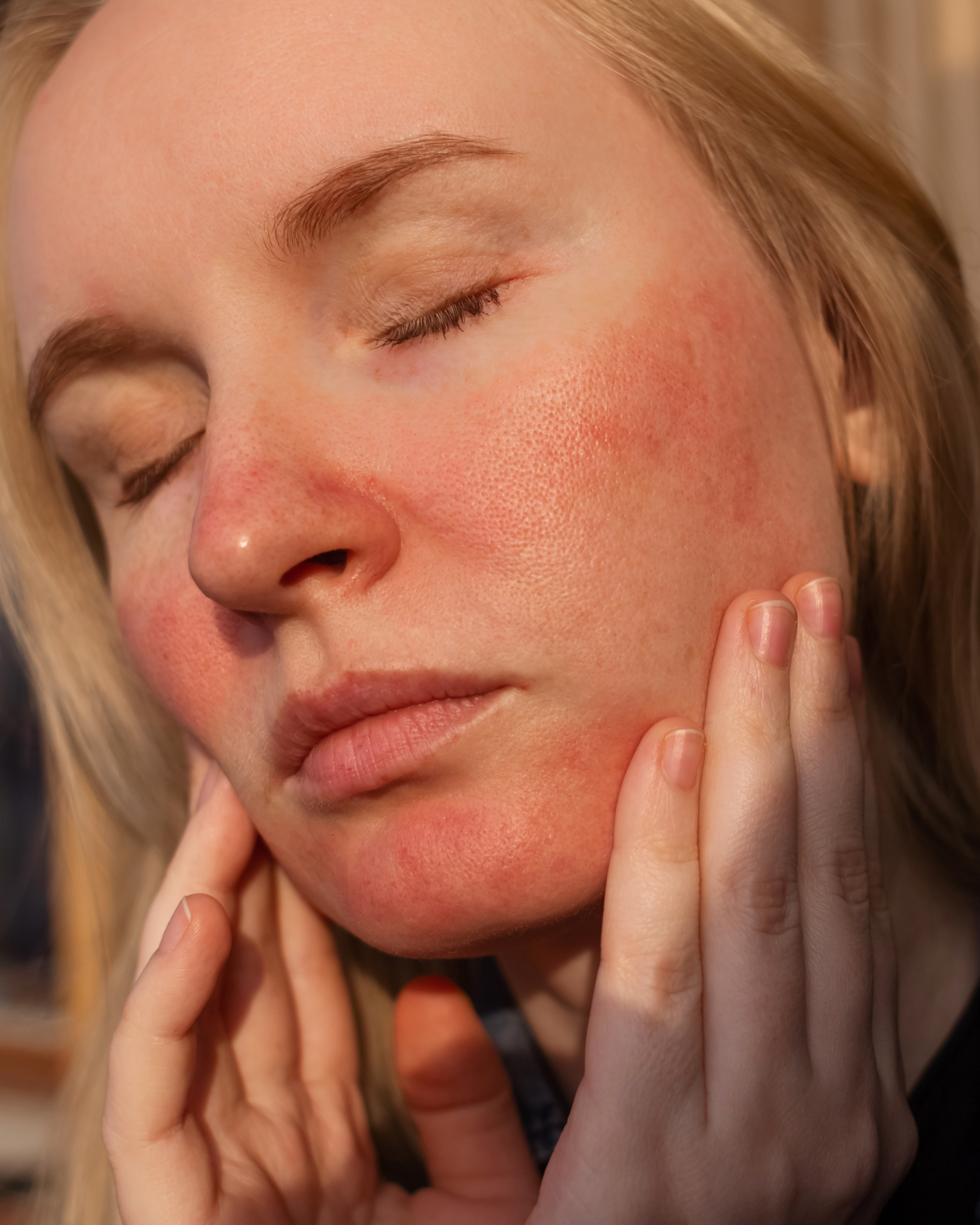 Rosacea or Sensitive Skin? How To Tell The Difference