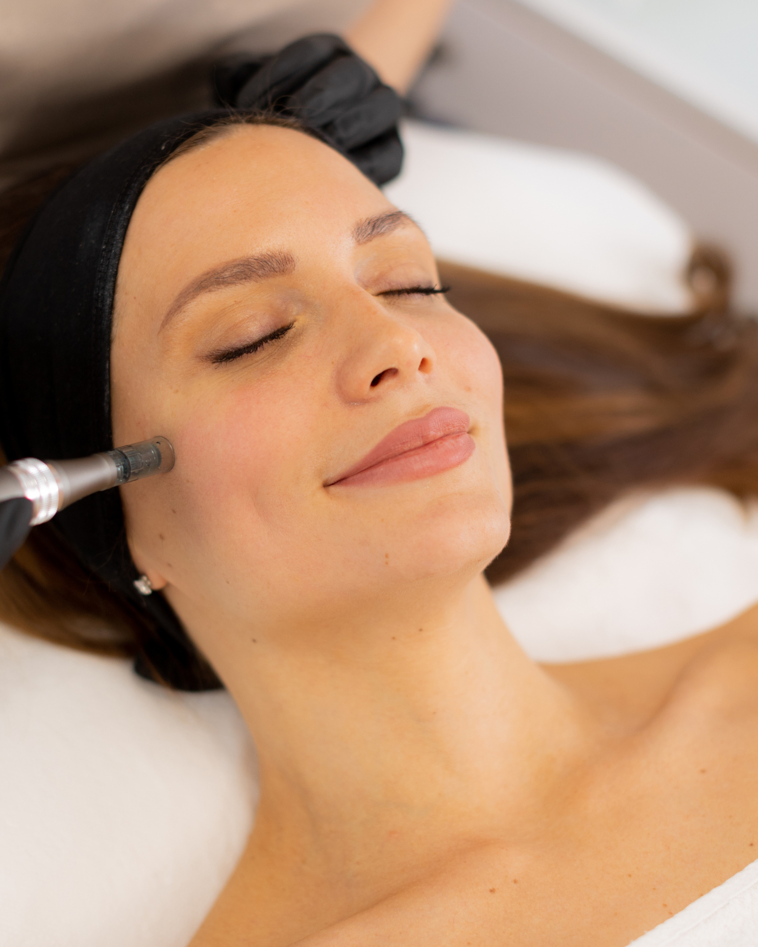 Should You Bleed During Microneedling? What the Latest Evidence Actually Shows