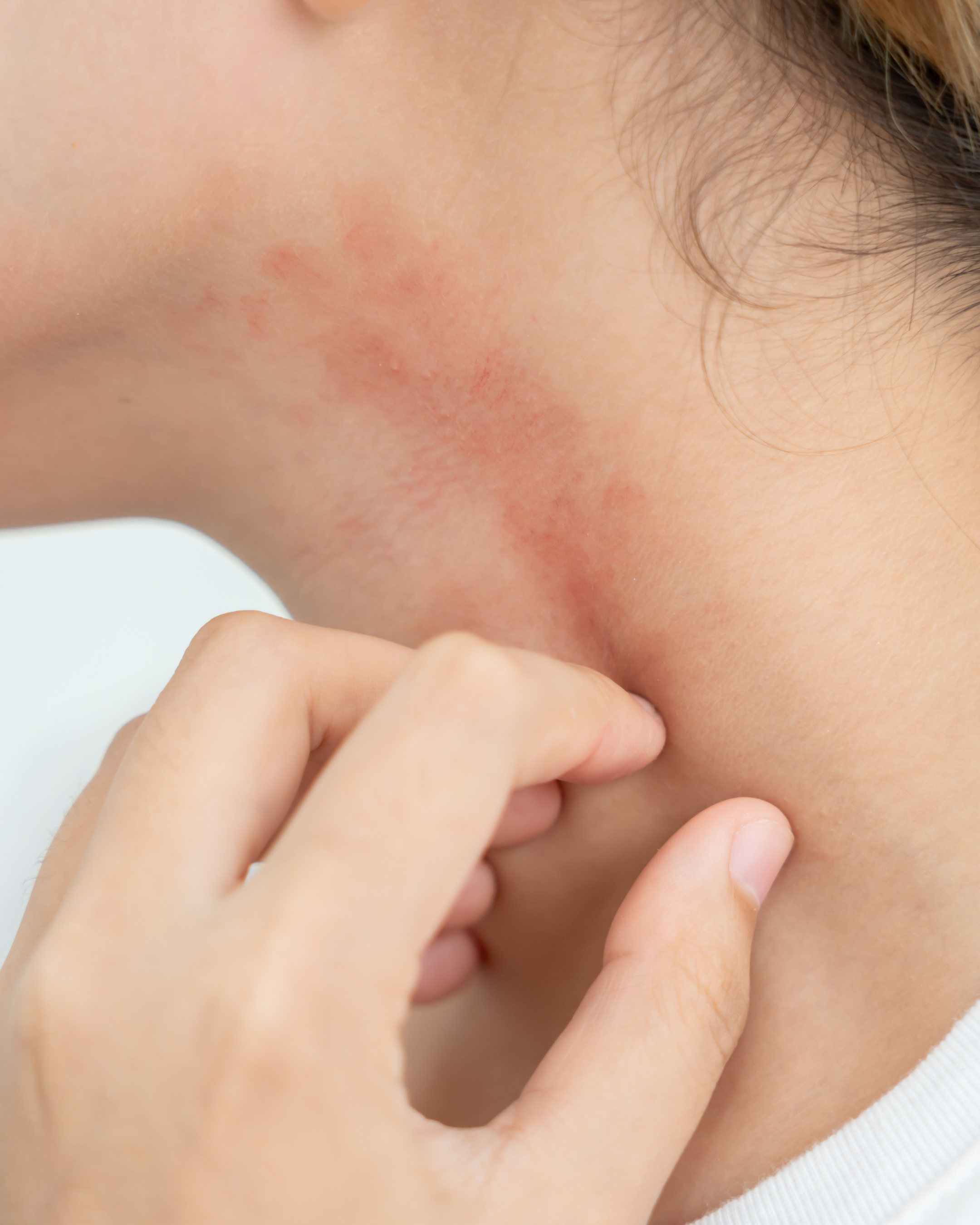 Why Is My Skin Suddenly Sensitive?