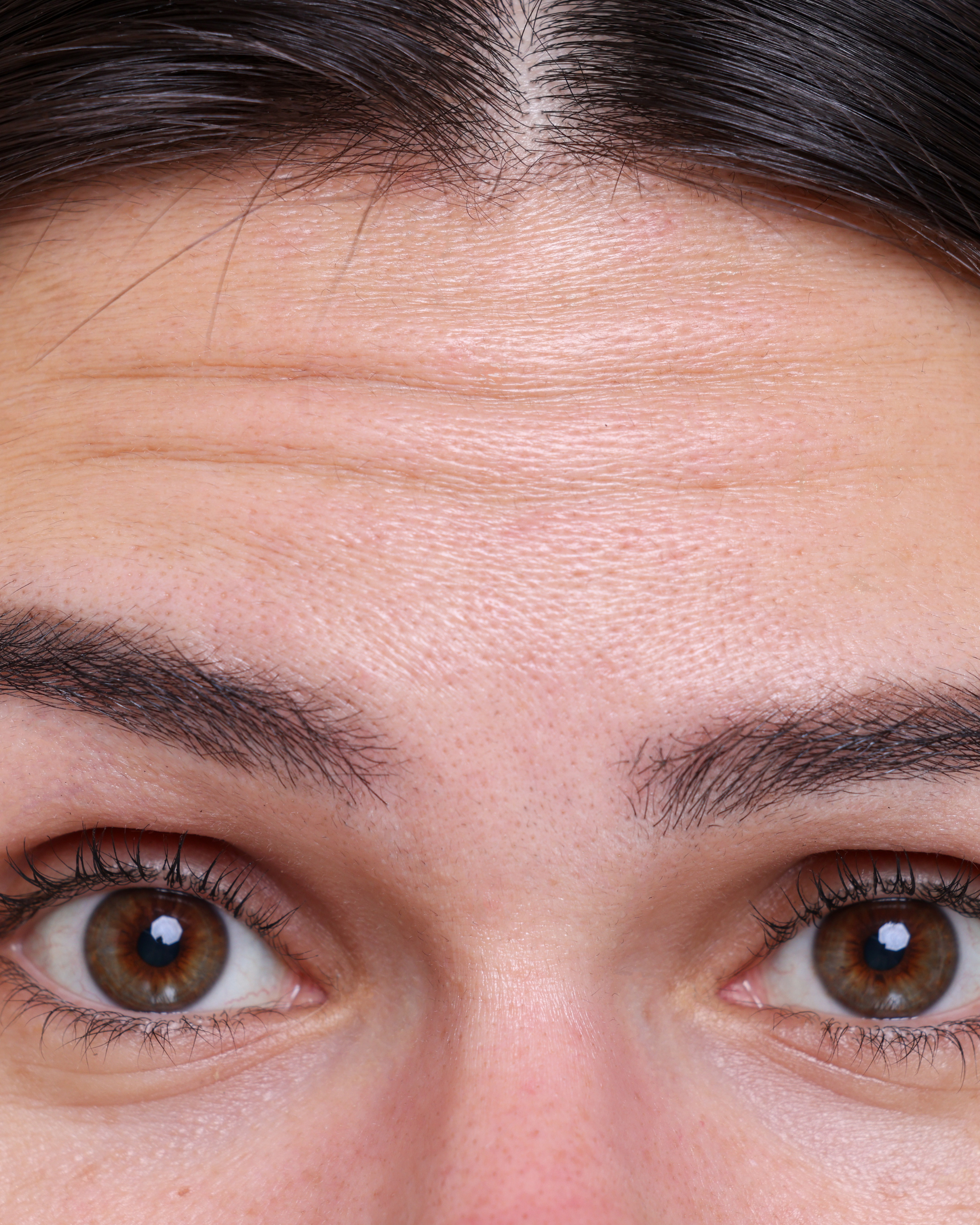 What Happens If You Stop Having Anti-Wrinkle Injections?