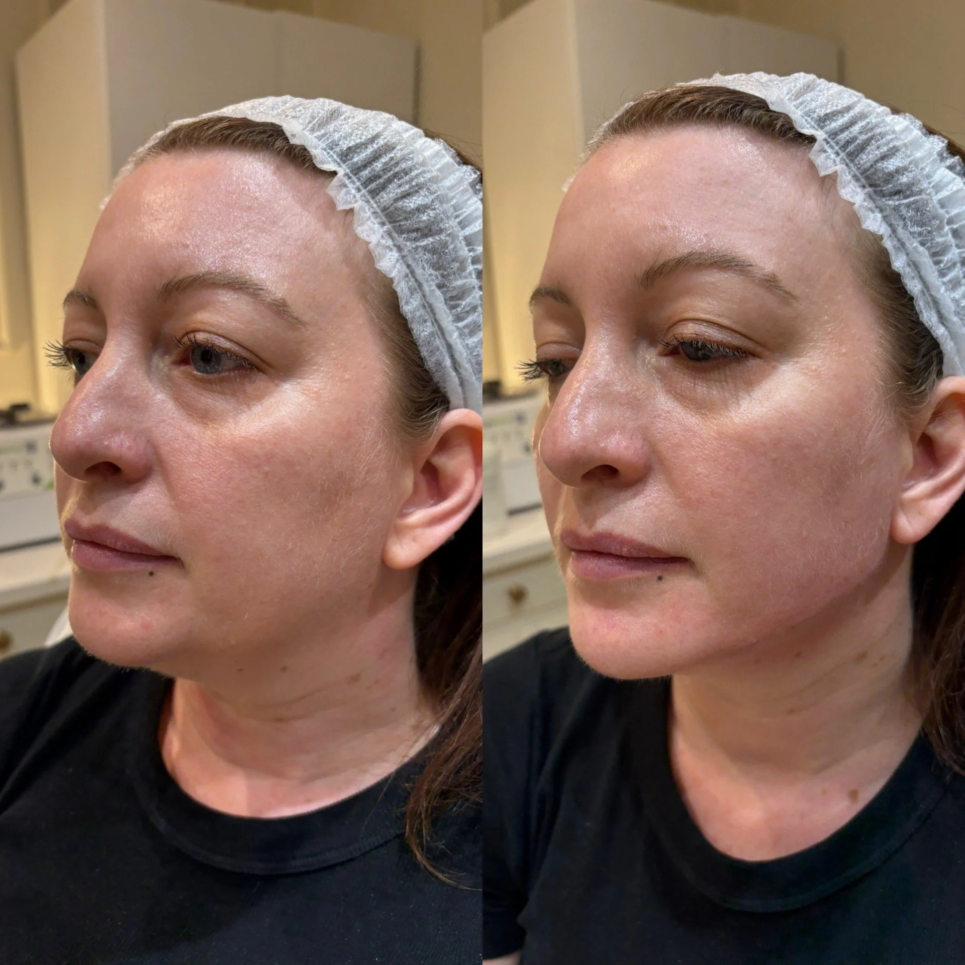 Why Is Radiesse So Effective for Jawline Definition?