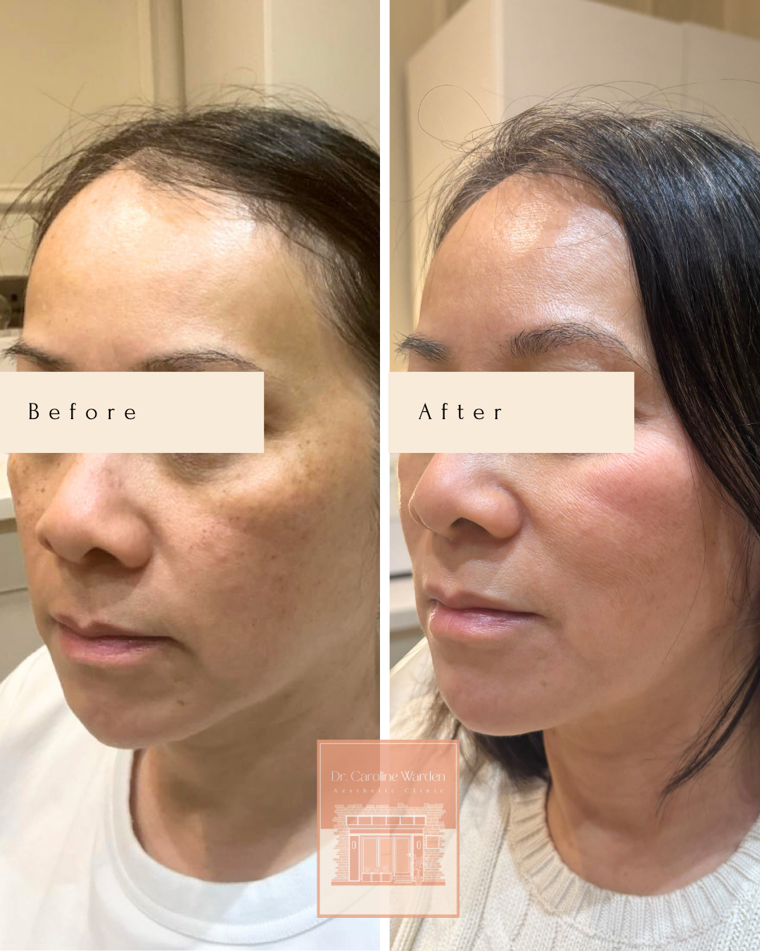 Angled before and after Obagi Nu-Derm showing improvement in pigmentation and uneven skin tone